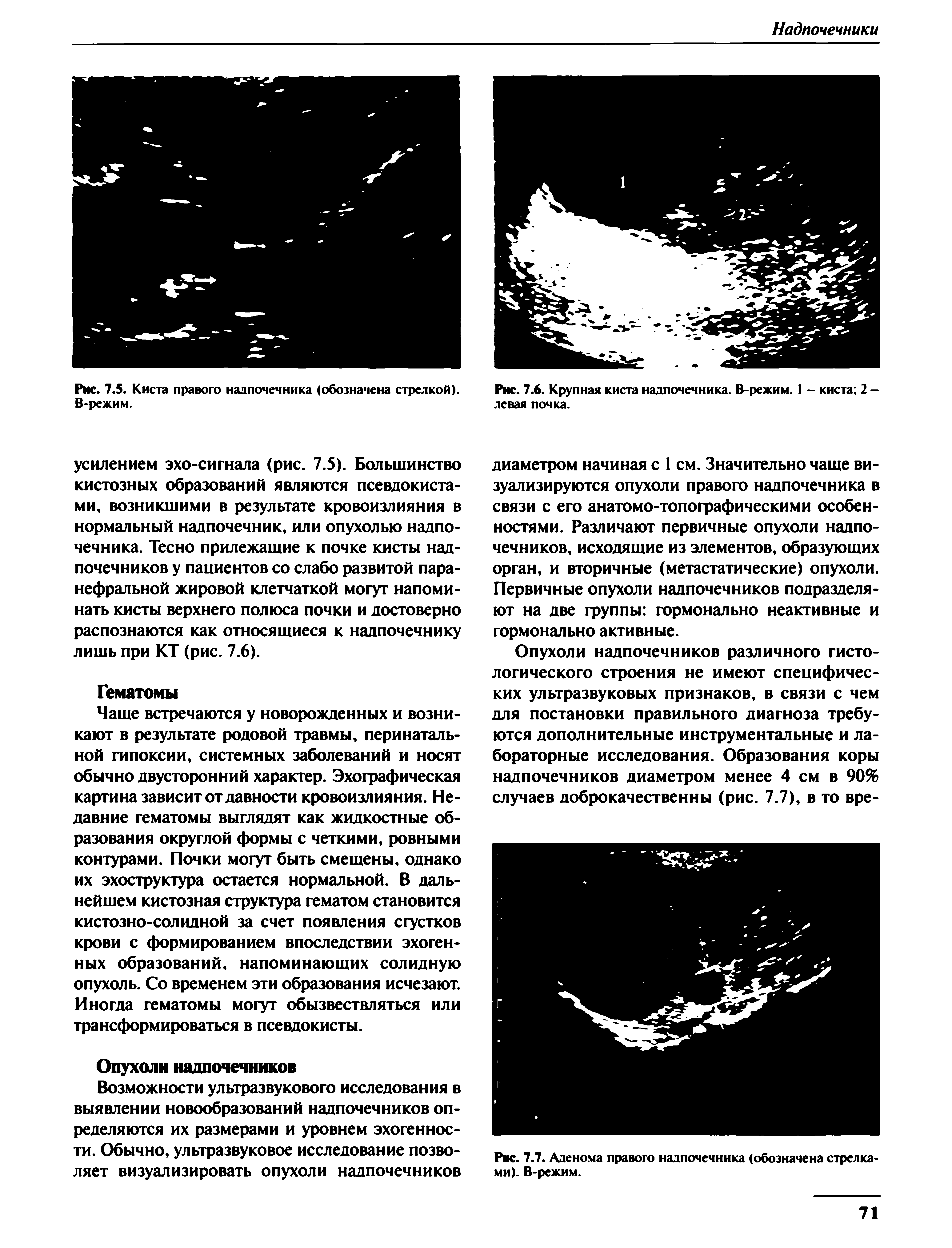 Рис. 7.6. Крупная киста надпочечника. В-режим. I - киста 2 -левая почка.