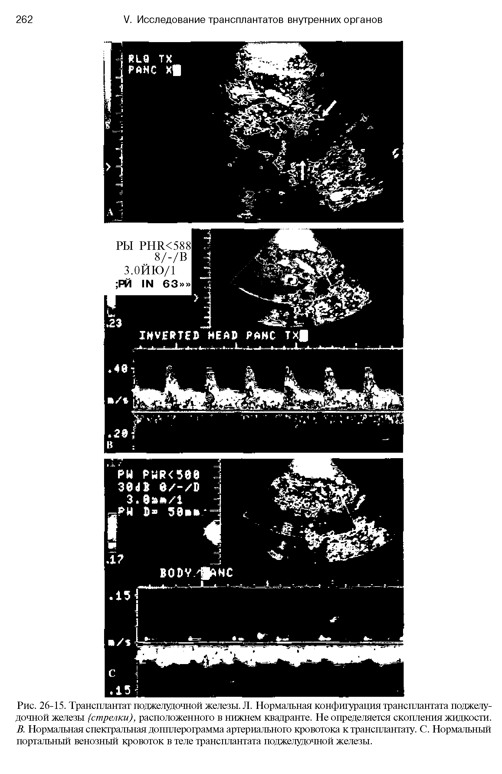 Рис. 26-15. Трансплантат поджелудочной железы. Л. Нормальная конфигурация трансплантата поджелудочной железы (стрелки), расположенного в нижнем квадранте. Не определяется скопления жидкости. В. Нормальная спектральная допплерограмма артериального кровотока к трансплантату. С. Нормальный портальный венозный кровоток в теле трансплантата поджелудочной железы.