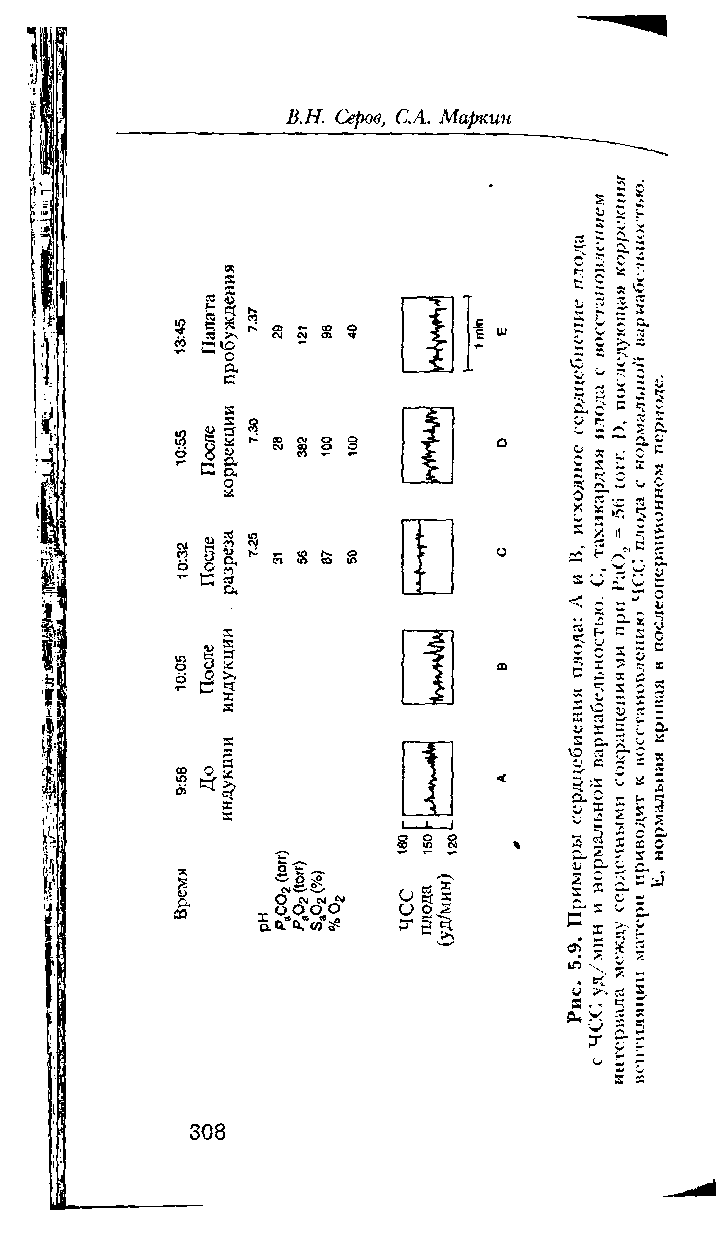 Рис. 5.9. Примеры сердцебиения плода . А и В, исходное сердцебиение плода с ЧСС уд/мин и нормальной вариабельностью. С, тахикардия плода с иосс/апоилепием интервала между сердечными сокращениями при РаО., - 5( . I), последующая коррекция вентиляции. ма тери приводит к восстановлению ЧСС плода с нормальной вариабельностью. Е, нормальная кривая н послеоперационном периоде.