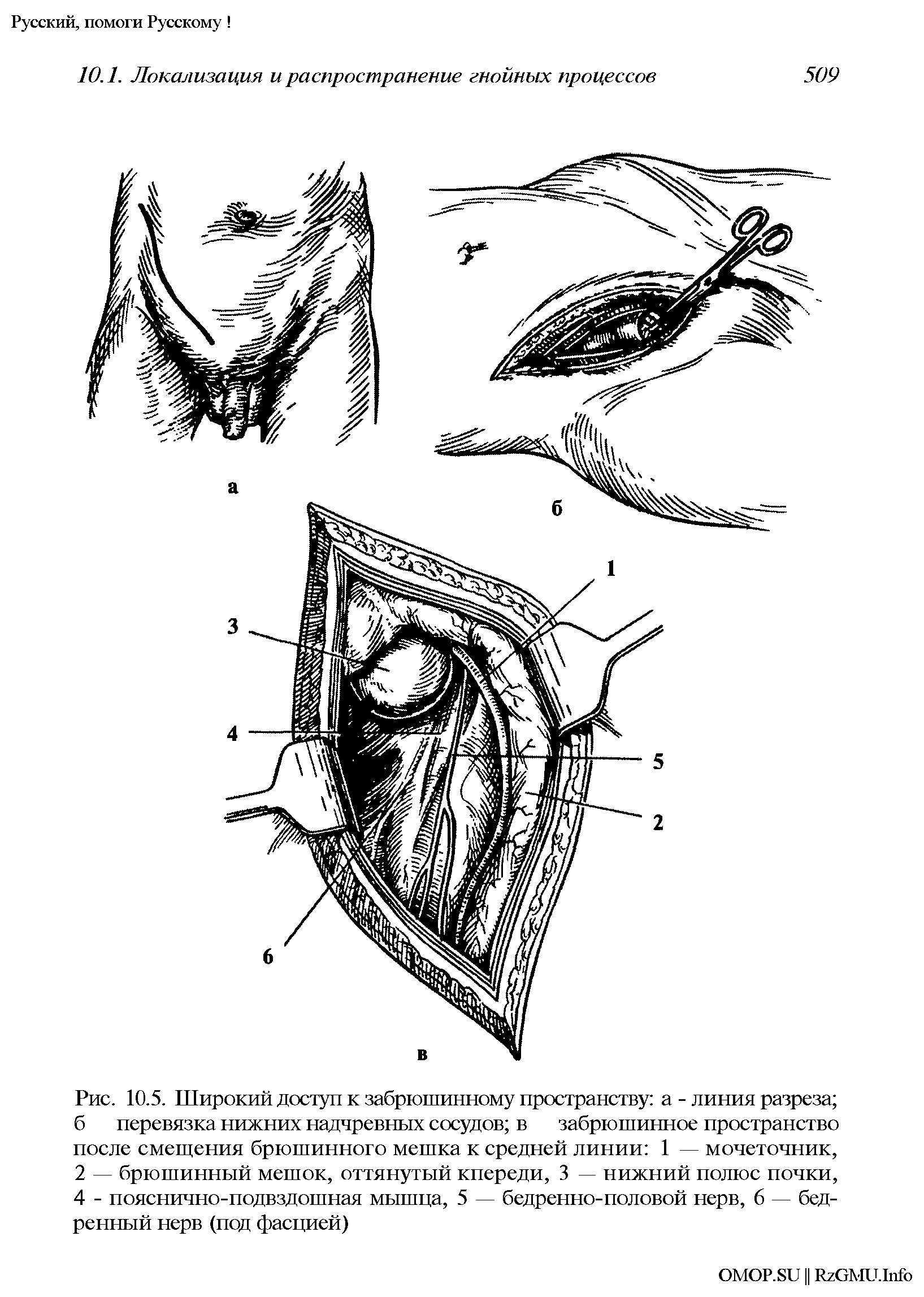 Рис. 10.5. Широкий доступ к забрюшинному пространству а - линия разреза б перевязка нижних надчревных сосудов в забрюшинное пространство после смещения брюшинного мешка к средней линии 1 — мочеточник, 2 — брюшинный мешок, оттянутый кпереди, 3 — нижний полюс почки, 4 - пояснично-подвздошная мышца, 5 — бедренно-половой нерв, 6 — бедренный нерв (под фасцией)...