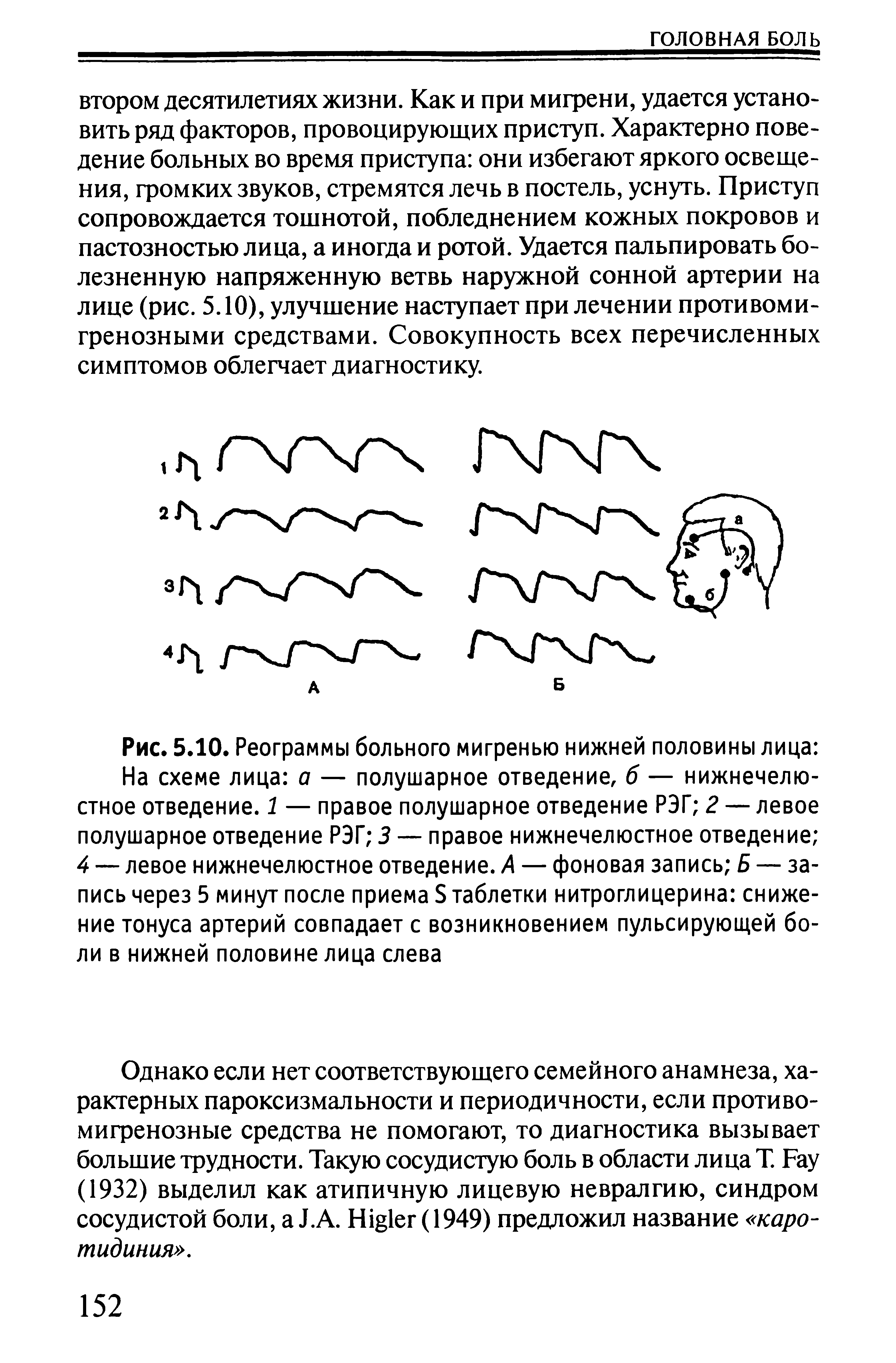 Рис. 5.10. Реограммы больного мигренью нижней половины лица ...