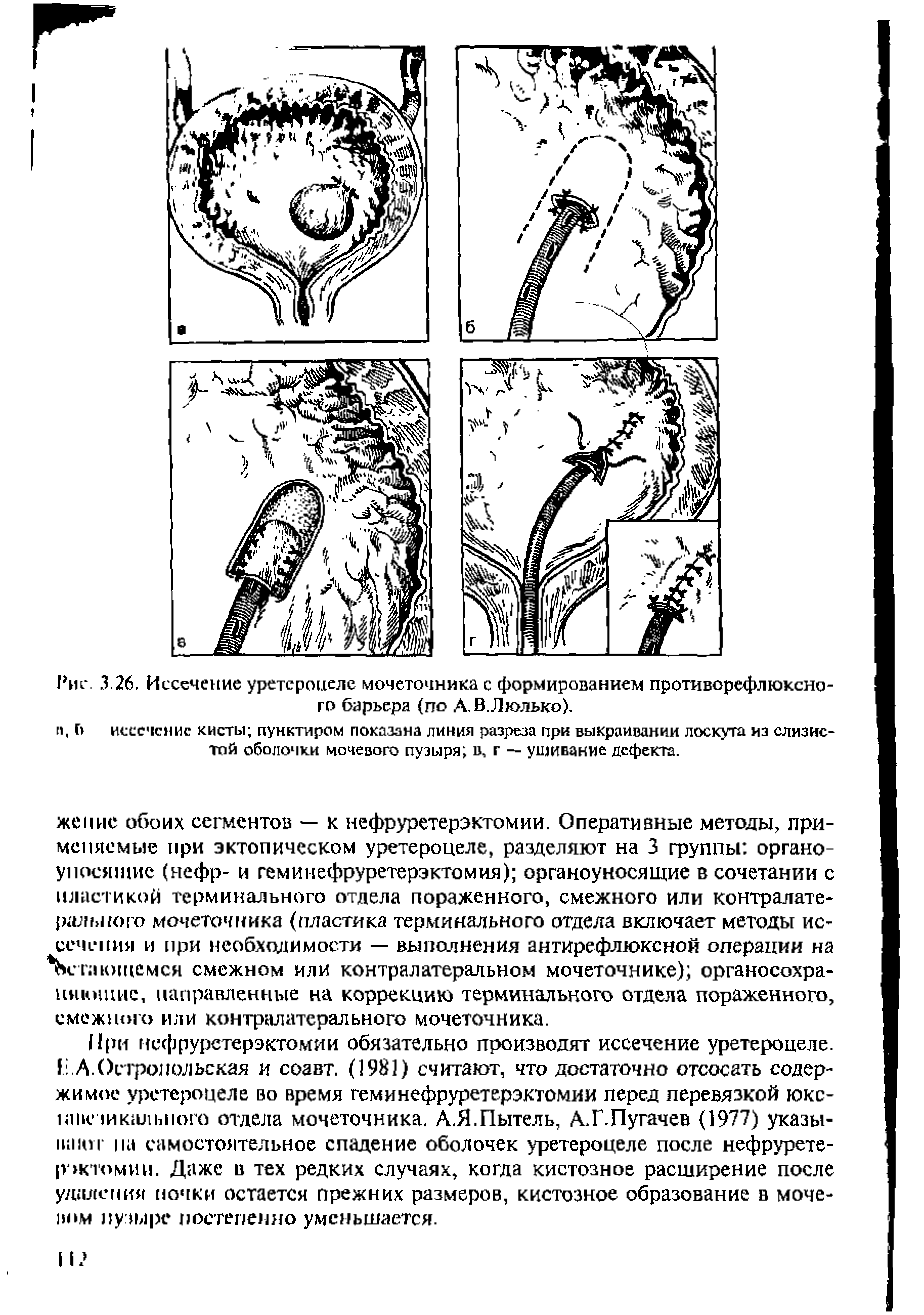 Рис. 3.26, Иссечение уретероцеле мочеточника с формированием противорефлюксно-го барьера (по А. В.Люлько).