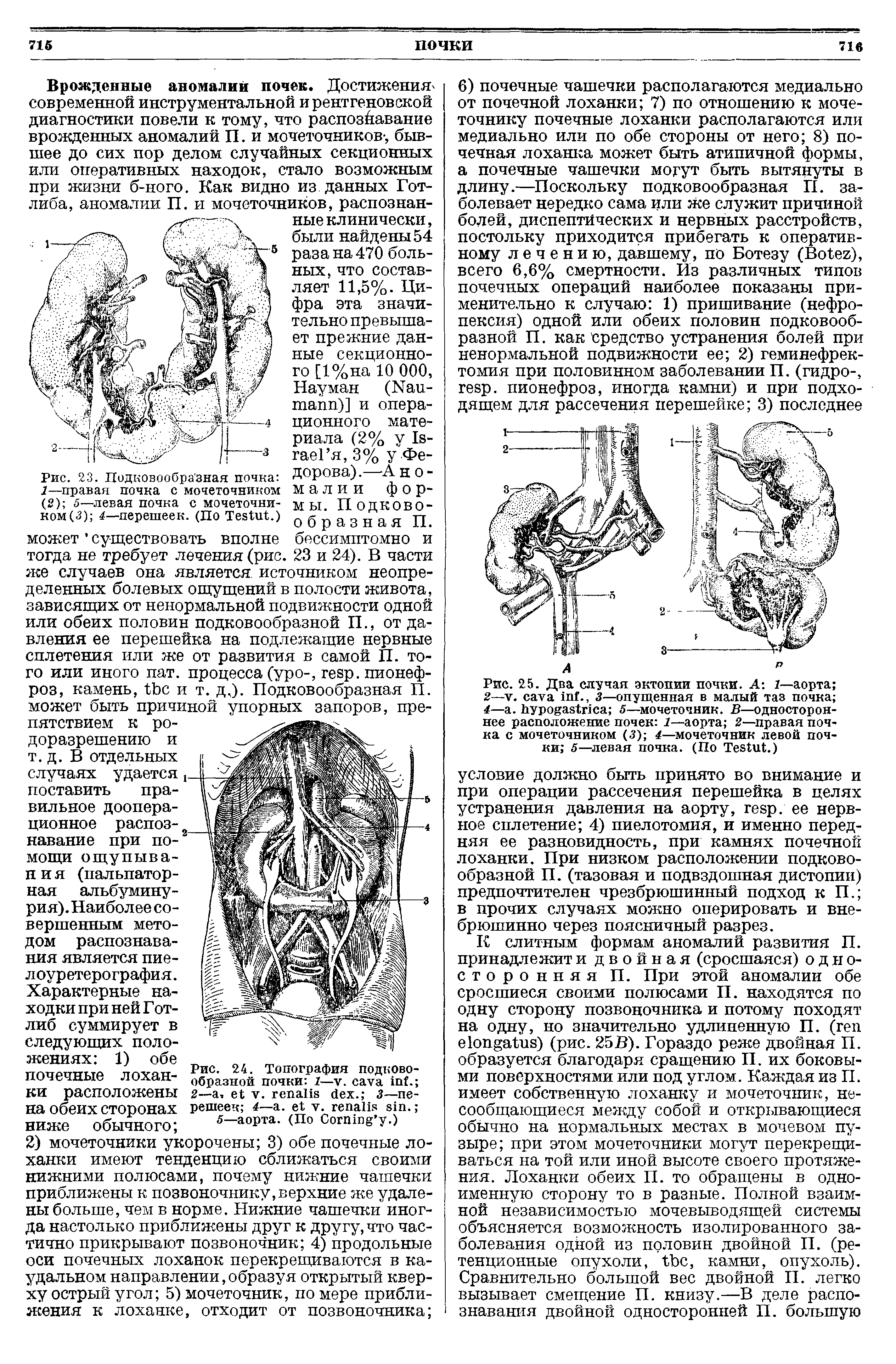 Рис. 25. Два случая эктопии почки. А-. 1—аорта 2—V. ., 3—опущенная в малый таз почка 4— . 5—мочеточник. В—одностороннее расположение почек 1—аорта 2—правая почка с мочеточником (3) 4—мочеточник левой почки 5—левая почка. (По T .)...