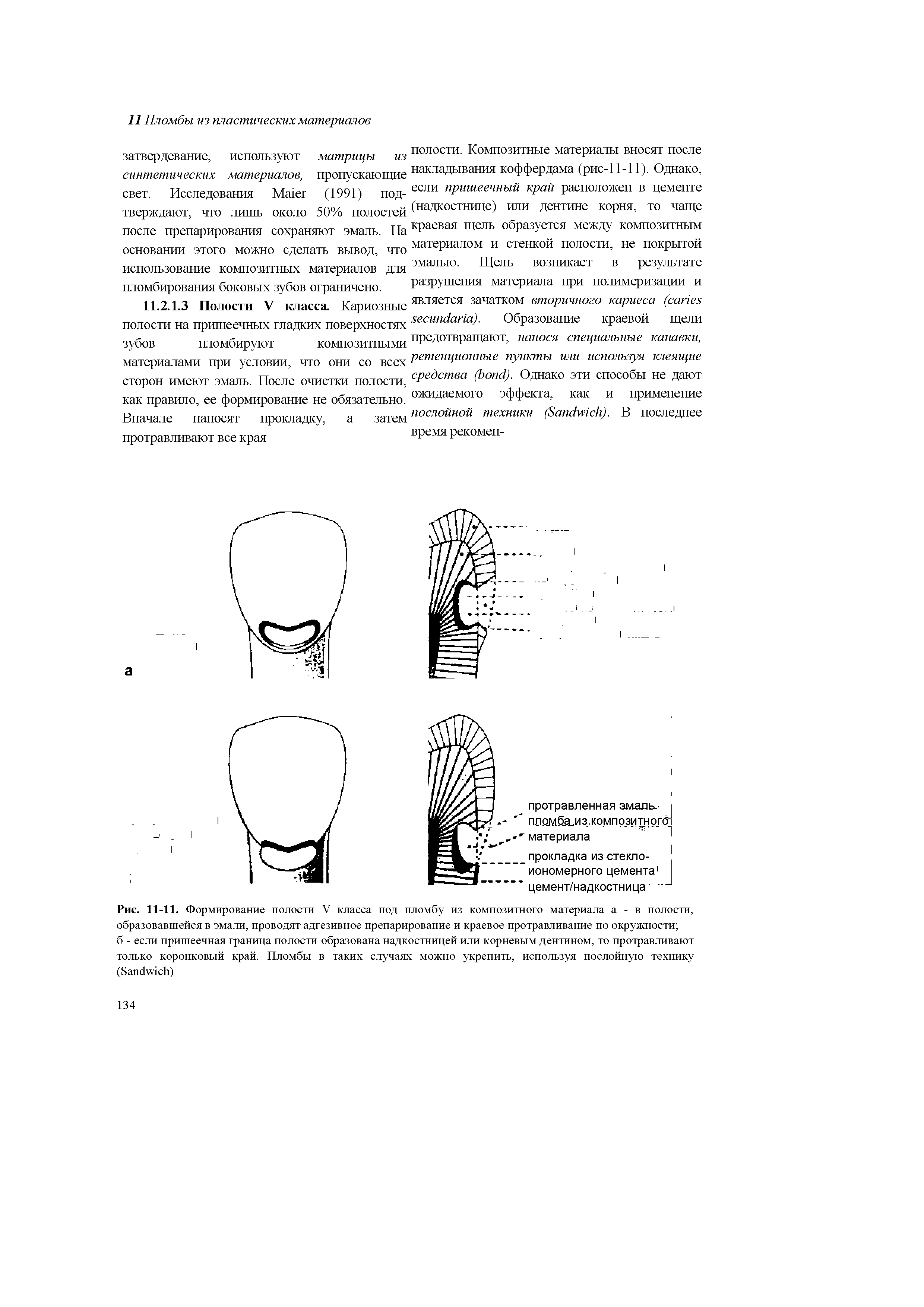 Рис. 11-11. Формирование полости V класса под пломбу из композитного материала а - в полости, образовавшейся в эмали, проводят адгезивное препарирование и краевое протравливание по окружности ...