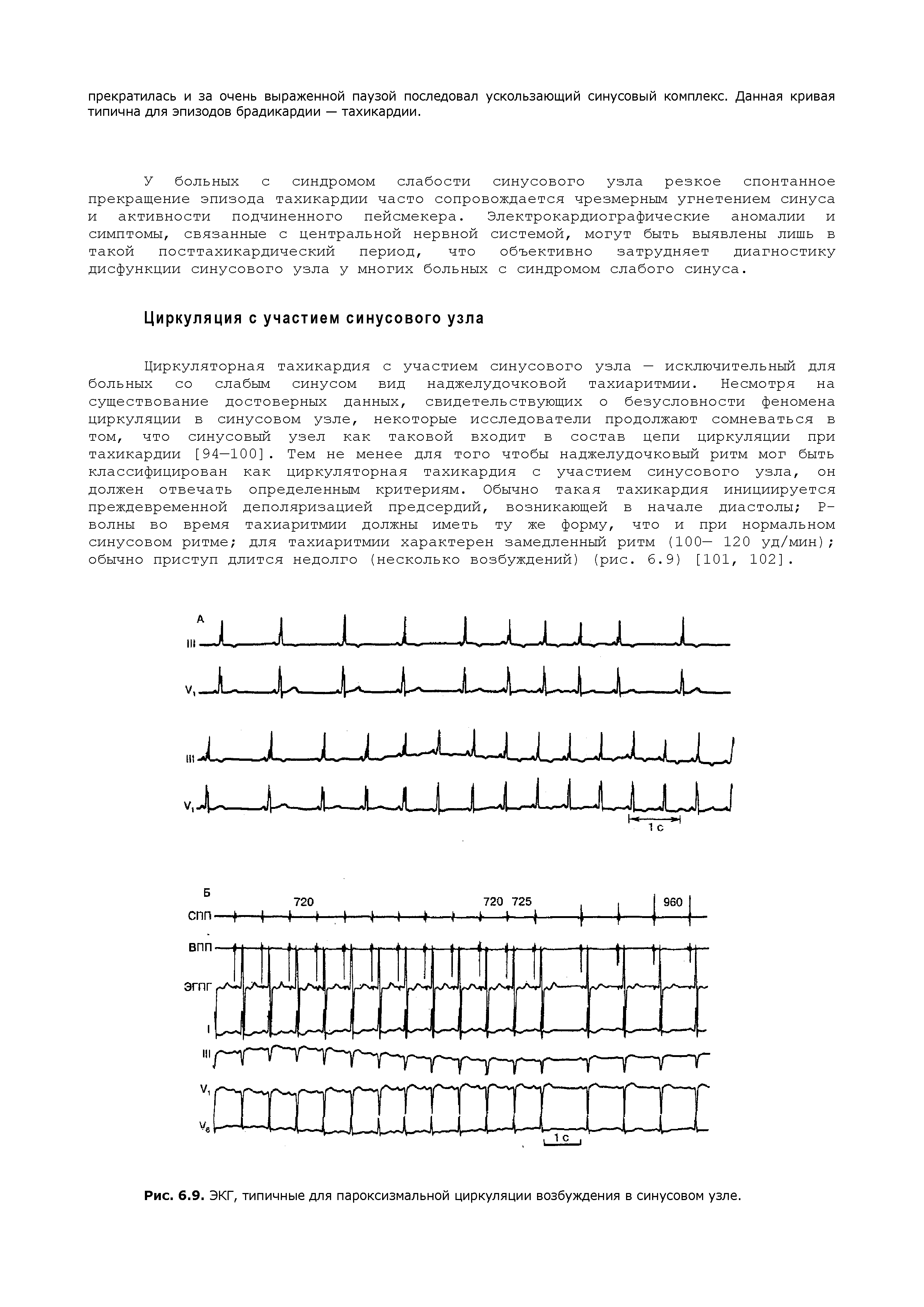 Рис. 6.9. ЭКГ, типичные для пароксизмальной циркуляции возбуждения в синусовом узле.