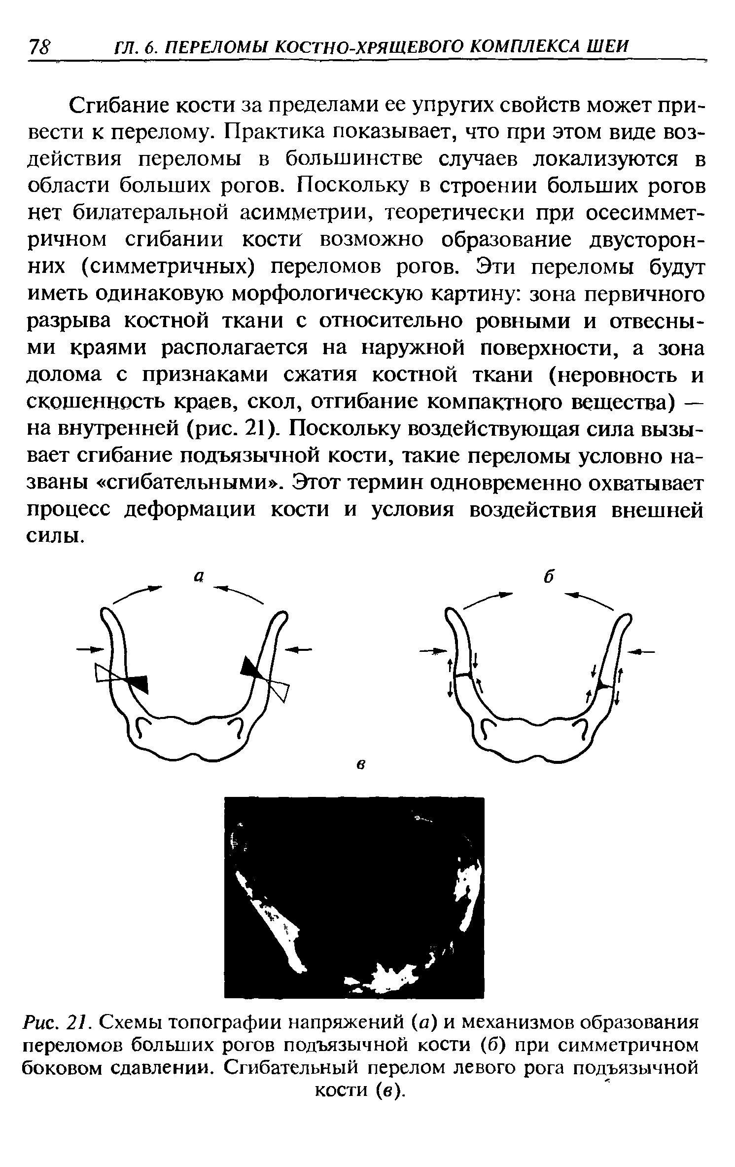 Рис. 21. Схемы топографии напряжений (а) и механизмов образования переломов больших рогов подъязычной кости (б) при симметричном боковом сдавлении. Сгибательный перелом левого рога подъязычной кости (в).