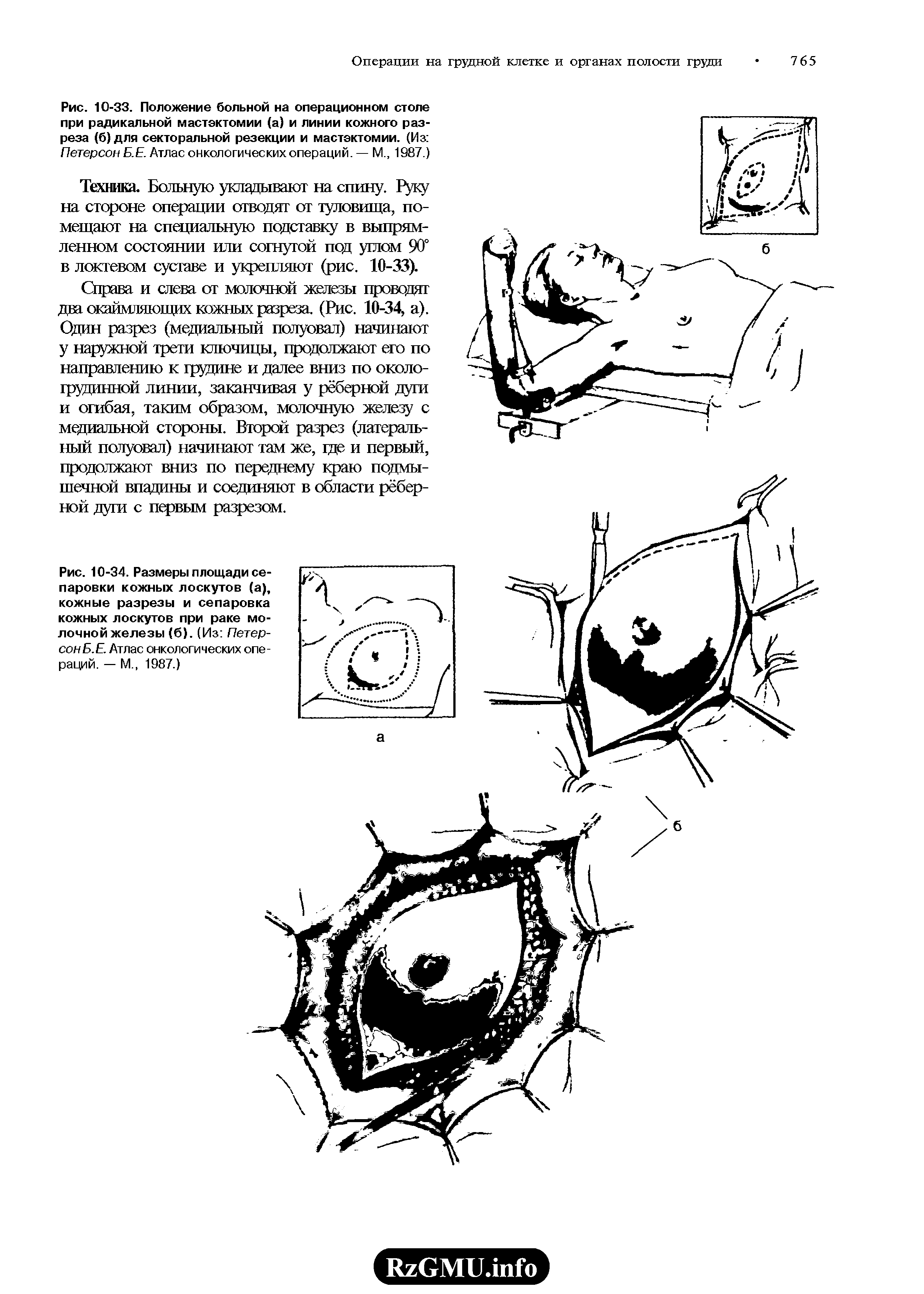 Рис. 10-33. Положение больной на операционном столе при радикальной мастэктомии (а) и линии кожного разреза (б) для секторальной резекции и мастэктомии. (Из Петерсон Б.Е. Атлас онкологических операций, — М., 1987.)...