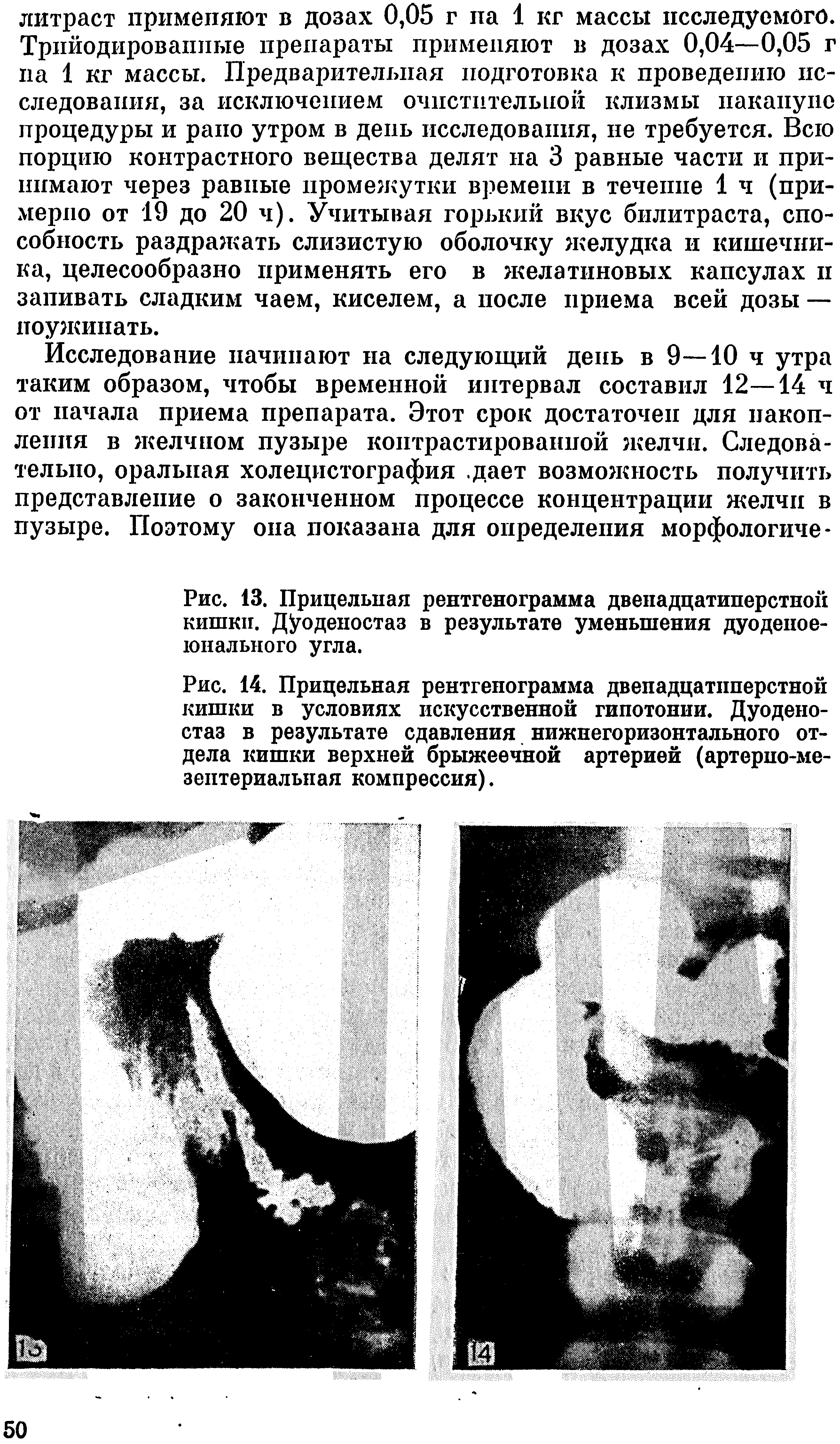 Рис. 14. Прицельная рентгенограмма двенадцатиперстной кишки в условиях искусственной гипотонии. Дуодено-стаз в результате сдавления нижнегоризонтального отдела кишки верхней брыжеечной артерией (артерпо-ме-зептериальпая компрессия).