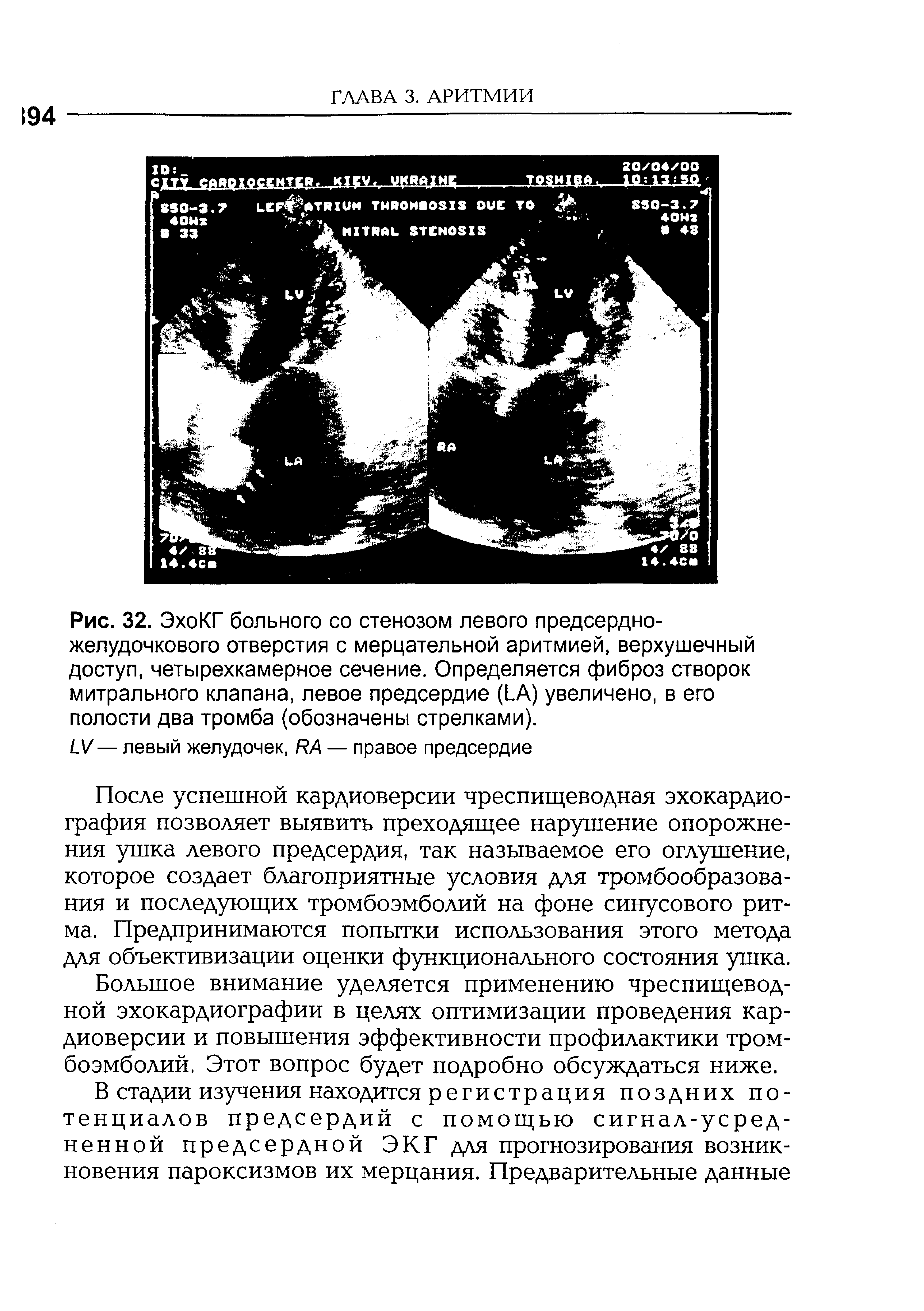 Рис. 32. ЭхоКГ больного со стенозом левого предсердно-желудочкового отверстия с мерцательной аритмией, верхушечный доступ, четырехкамерное сечение. Определяется фиброз створок митрального клапана, левое предсердие (1 А) увеличено, в его полости два тромба (обозначены стрелками).