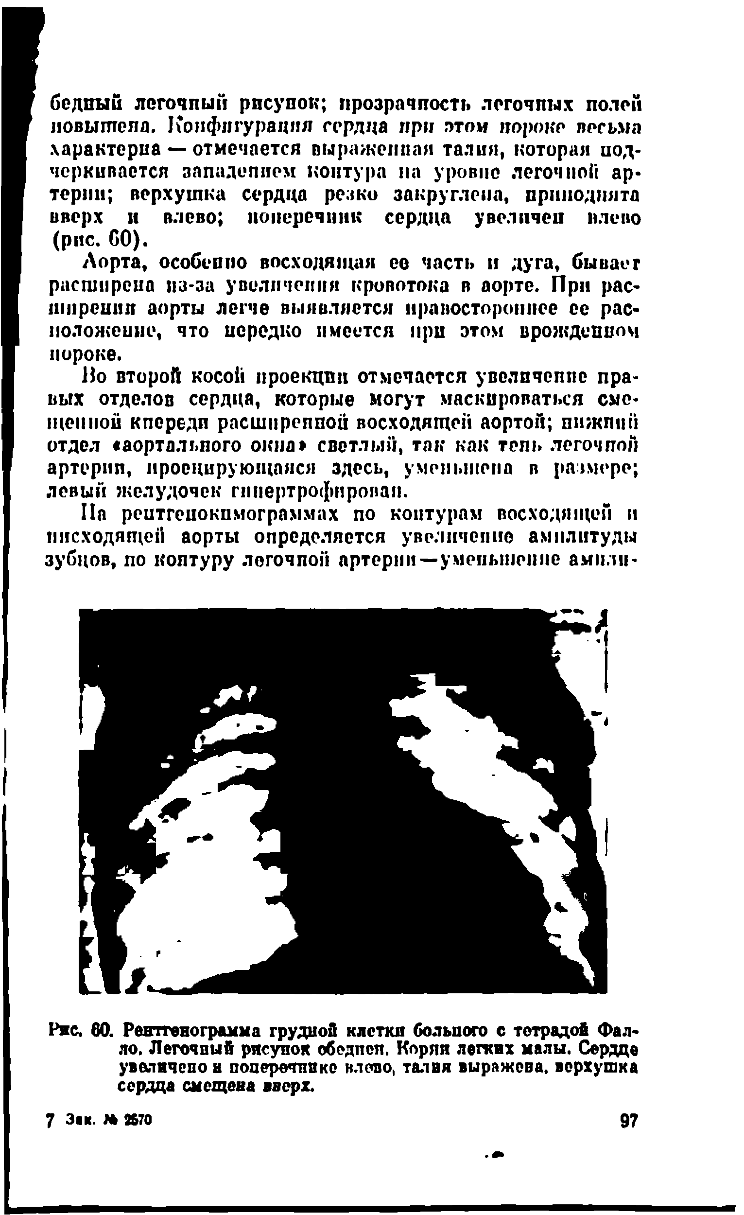 Рис. 60. Рентгенограмма грудной клетки больного с тетрадой Фалло. Легочный рисунок обедпеп. Корпи легких малы. Сердце увеличено в поперечинке нлото, талия выражева. верхушка сердца смещена вверх.