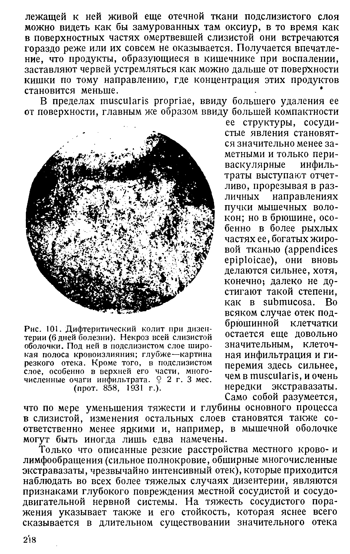 Рис. 101. Дифтеритический колит при дизентерии (6 дней болезни). Некроз всей слизистой оболочки. Под ней в подслизистом слое широкая полоса кровоизлияния глубже—картина резкого отека. Кроме того, в подслизистом слое, особенно в верхней его части, многочисленные очаги инфильтрата. 2 г. 3 мес. (прот. 858, 1931 г.).