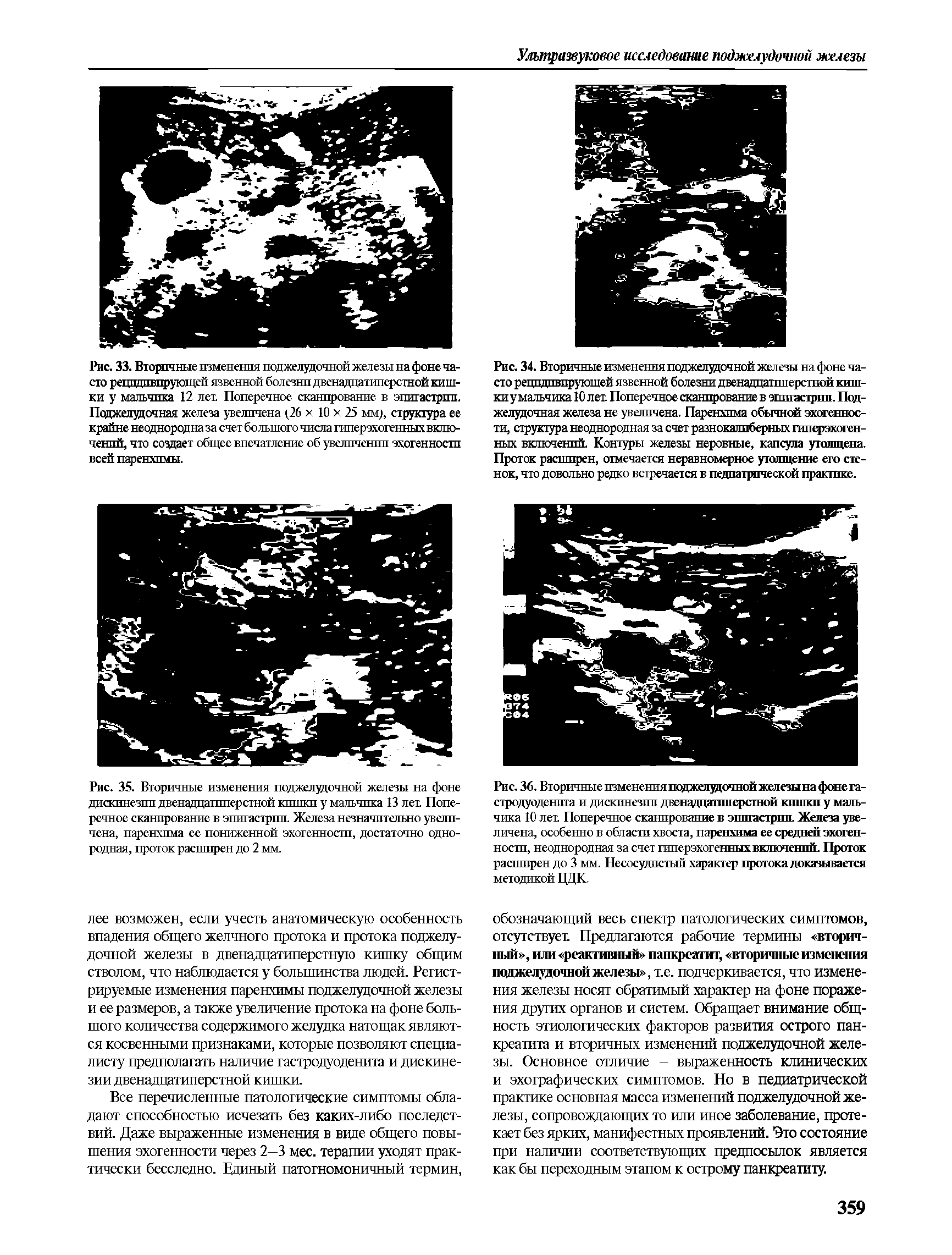 Рис. 35. Вторичные изменения поджелудочной железы на фоне дискинезии двенадцатиперстной кишки у мальчика 13 лет. Поперечное сканирование в эпигастрии. Железа незначительно увеличена, паренхима ее пониженной эхогенности, достаточно однородная, проток расширен до 2 мм.
