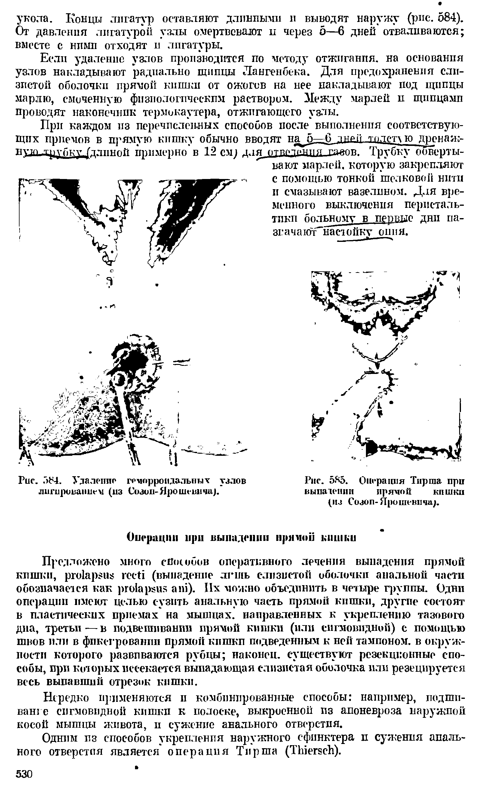 Рис. 5S5. Операция Тирша- при выпадении прямой кишки (из Созоп-Ярошевпча .