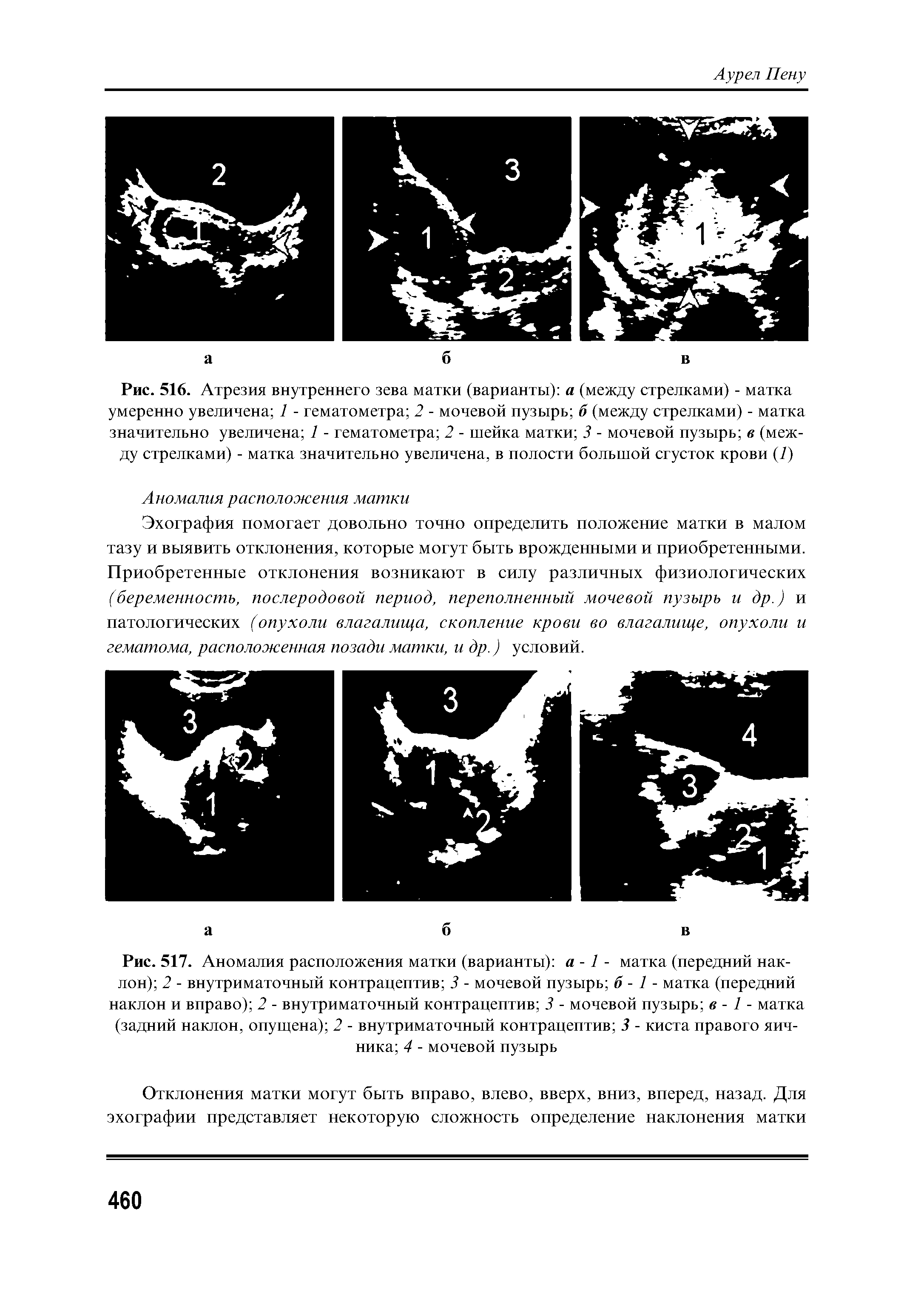 Рис. 517. Аномалия расположения матки (варианты) а -1 - матка (передний наклон) 2 - внутриматочный контрацептив 3 - мочевой пузырь б - 1 - матка (передний наклон и вправо) 2 - внутриматочный контрацептив 3 - мочевой пузырь в - 1 - матка (задний наклон, опущена) 2 - внутриматочный контрацептив 3 - киста правого яичника 4 - мочевой пузырь...