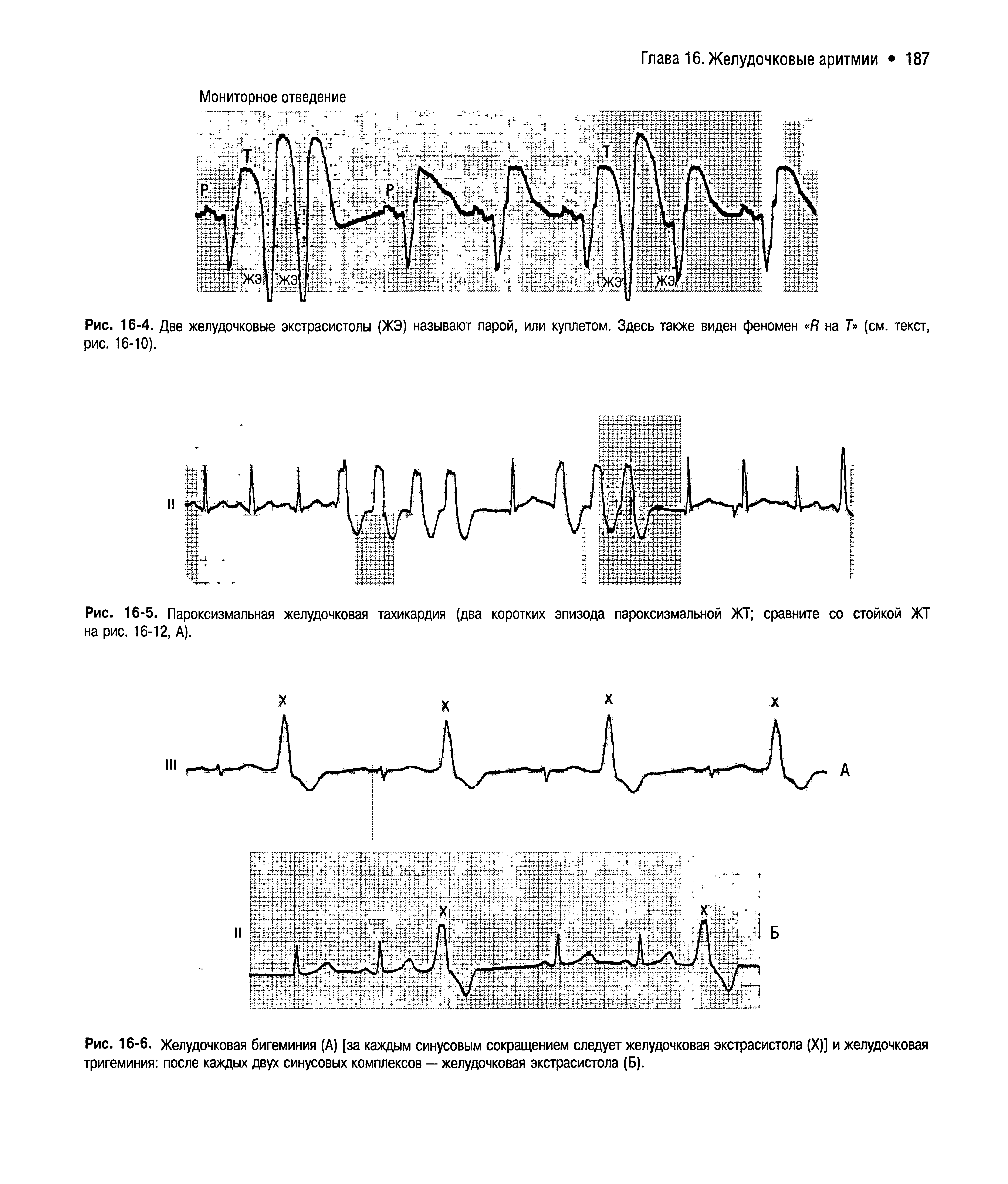 Рис. 16-6. Желудочковая бигеминия (А) [за каждым синусовым сокращением следует желудочковая экстрасистола (X)] и желудочковая тригеминия после каждых двух синусовых комплексов — желудочковая экстрасистола (Б).
