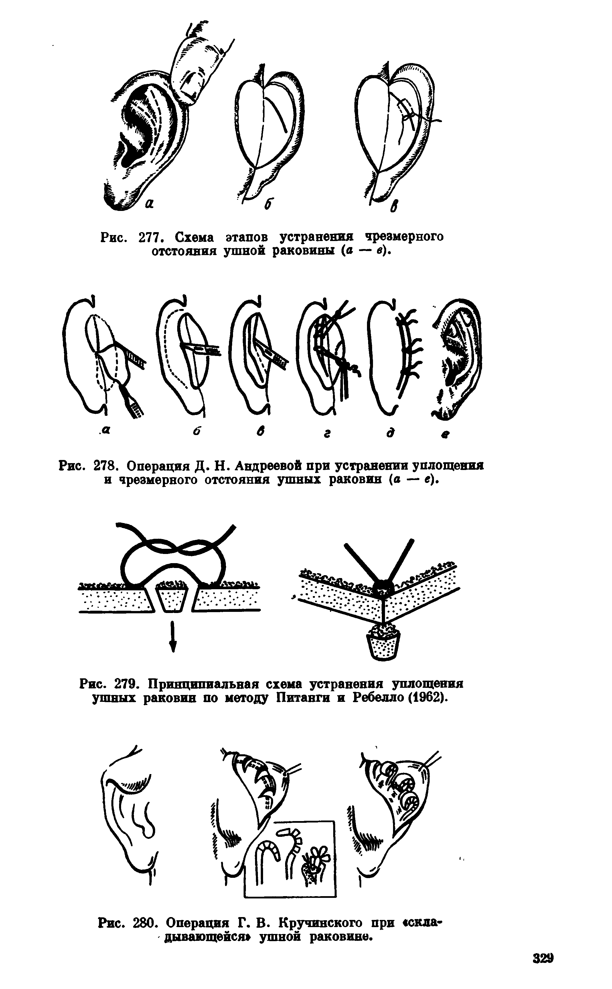 Рис. 279. Принципиальная схема устранения уплощения ушных раковин по методу Питанги и Ребелло (1962).