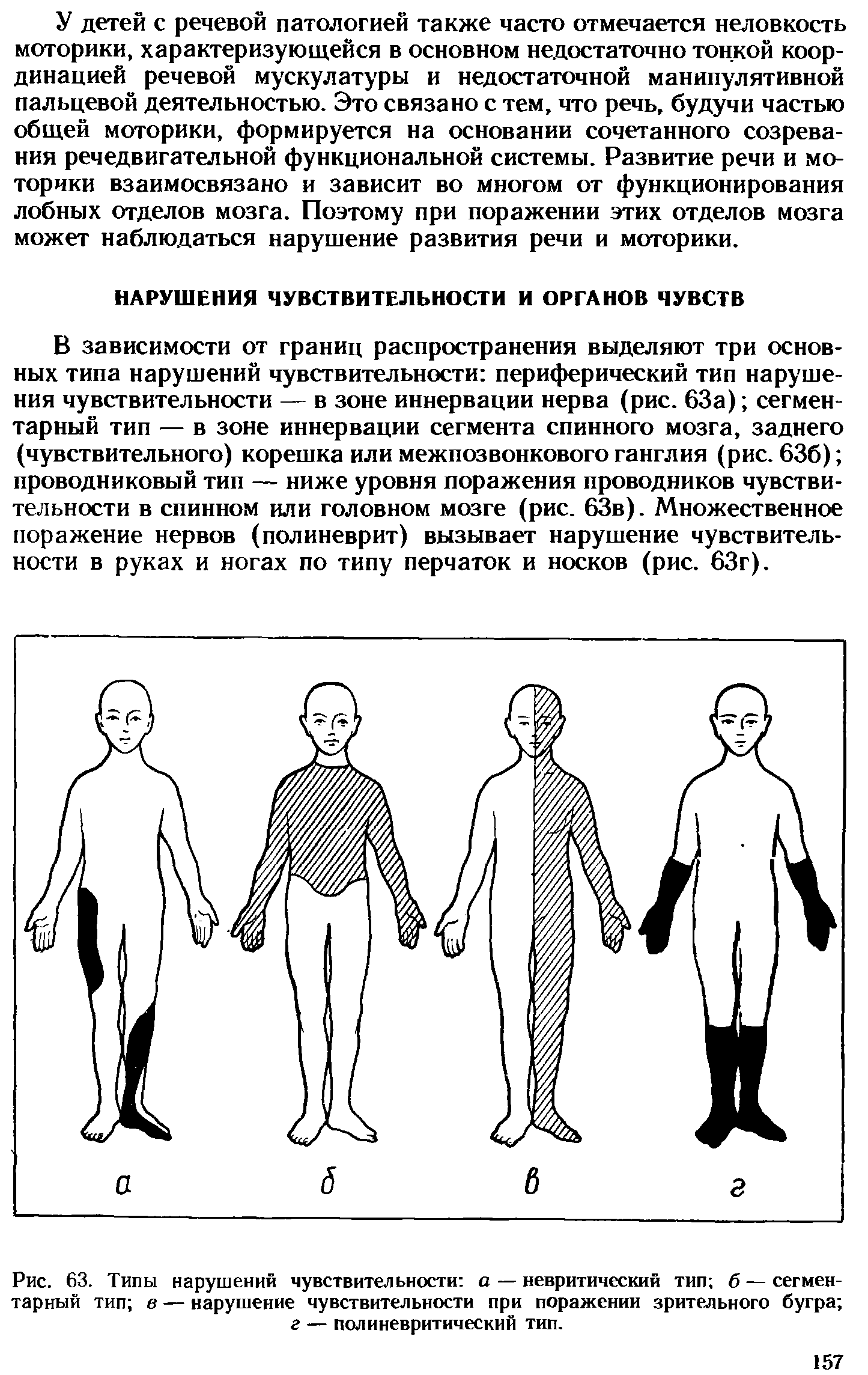 Рис. 63. Типы нарушений чувствительности а — невритический тип б — сегментарный тип в — нарушение чувствительности при поражении зрительного бугра г — полиневритический тип.