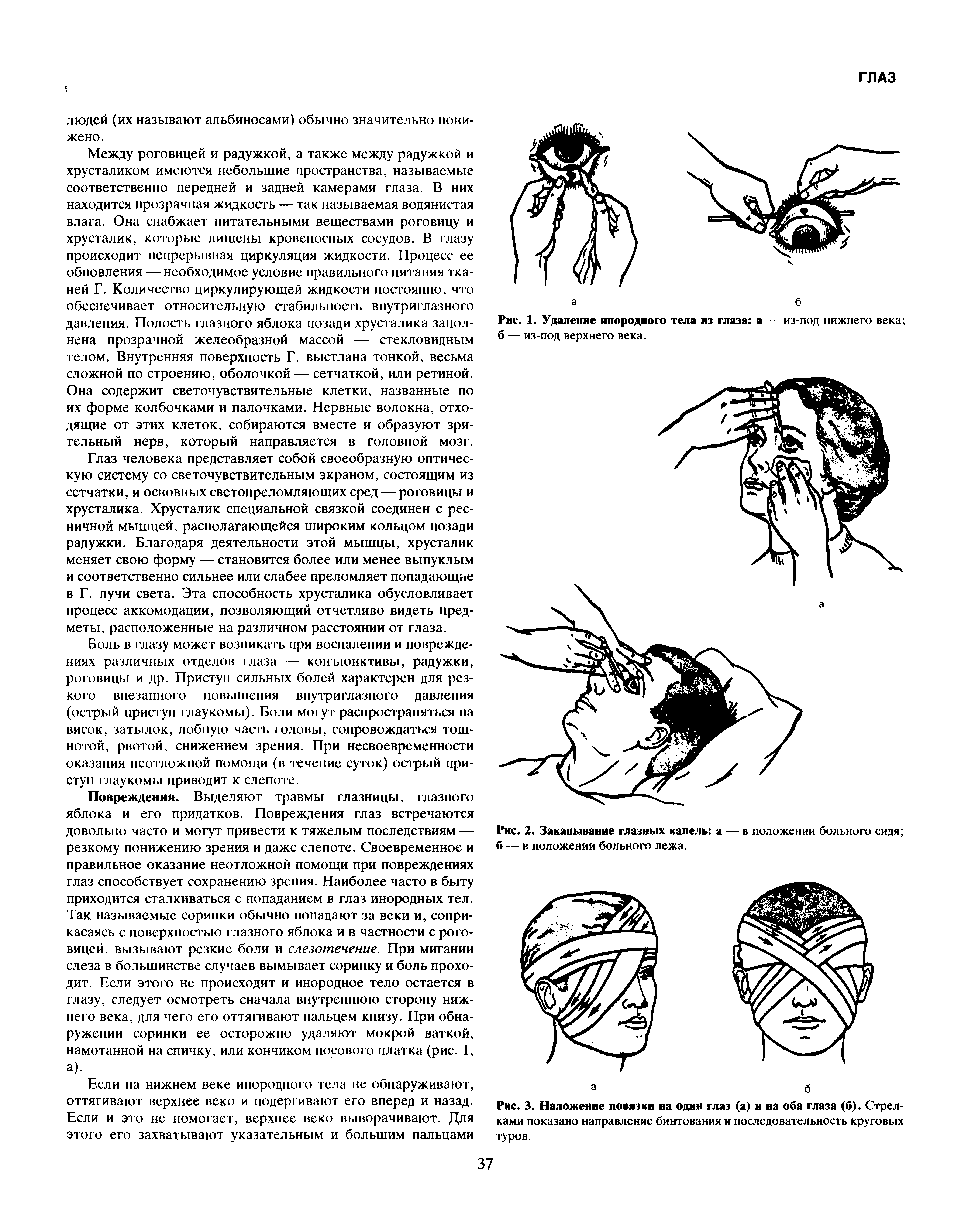 Рис. 3. Наложение повязки на один глаз (а) и на оба глаза (б). Стрелками показано направление бинтования и последовательность круговых туров.