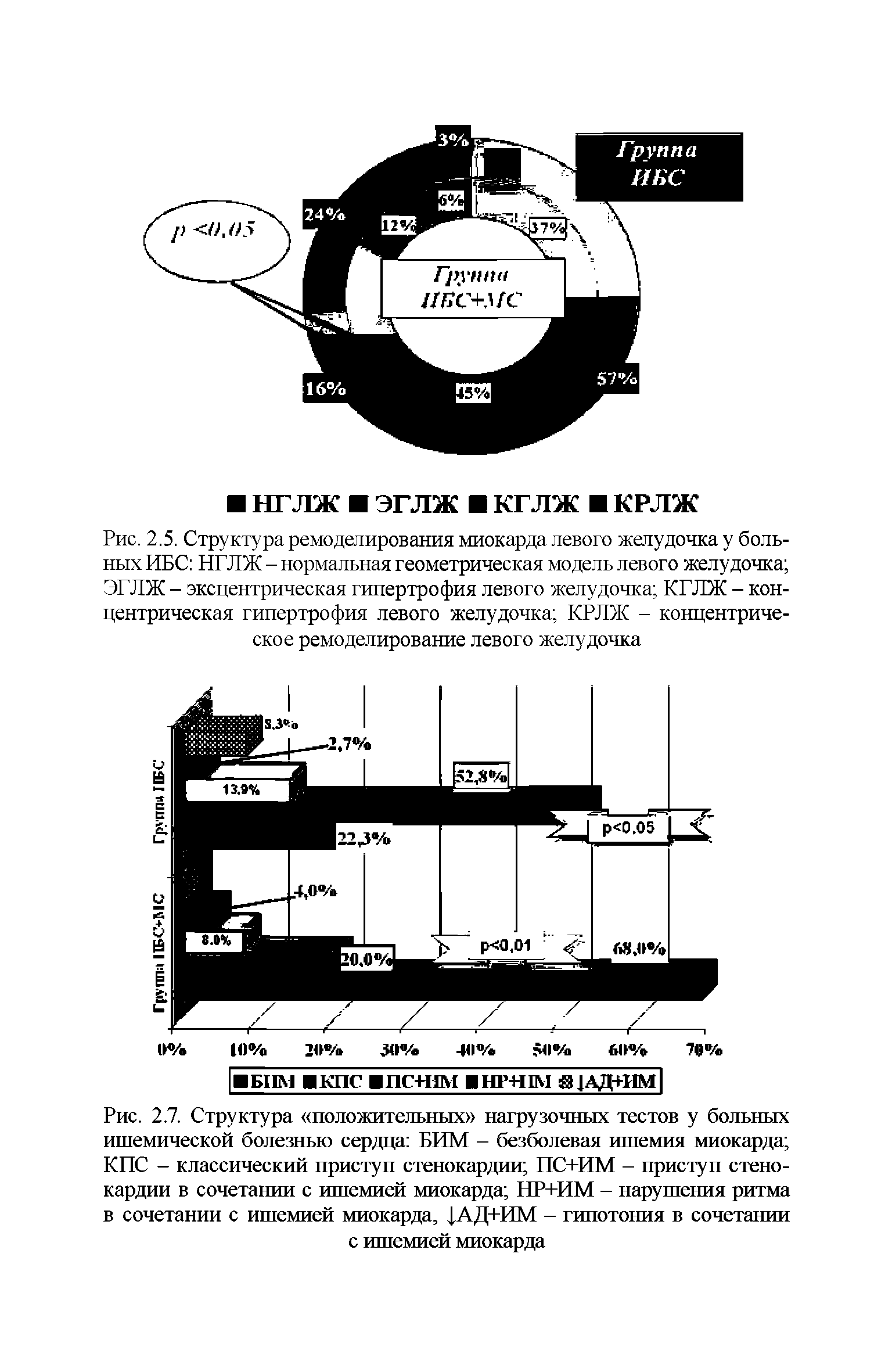 Рис. 2.5. Структура ремоделирования миокарда левого желудочка у больных ИБС НГЛЖ - нормальная геометрическая модель левого желудочка ЭГЛЖ - эксцентрическая гипертрофия левого желудочка КГЛЖ - концентрическая гипертрофия левого желудочка КРЛЖ - концентрическое ремоделирование левого желудочка...