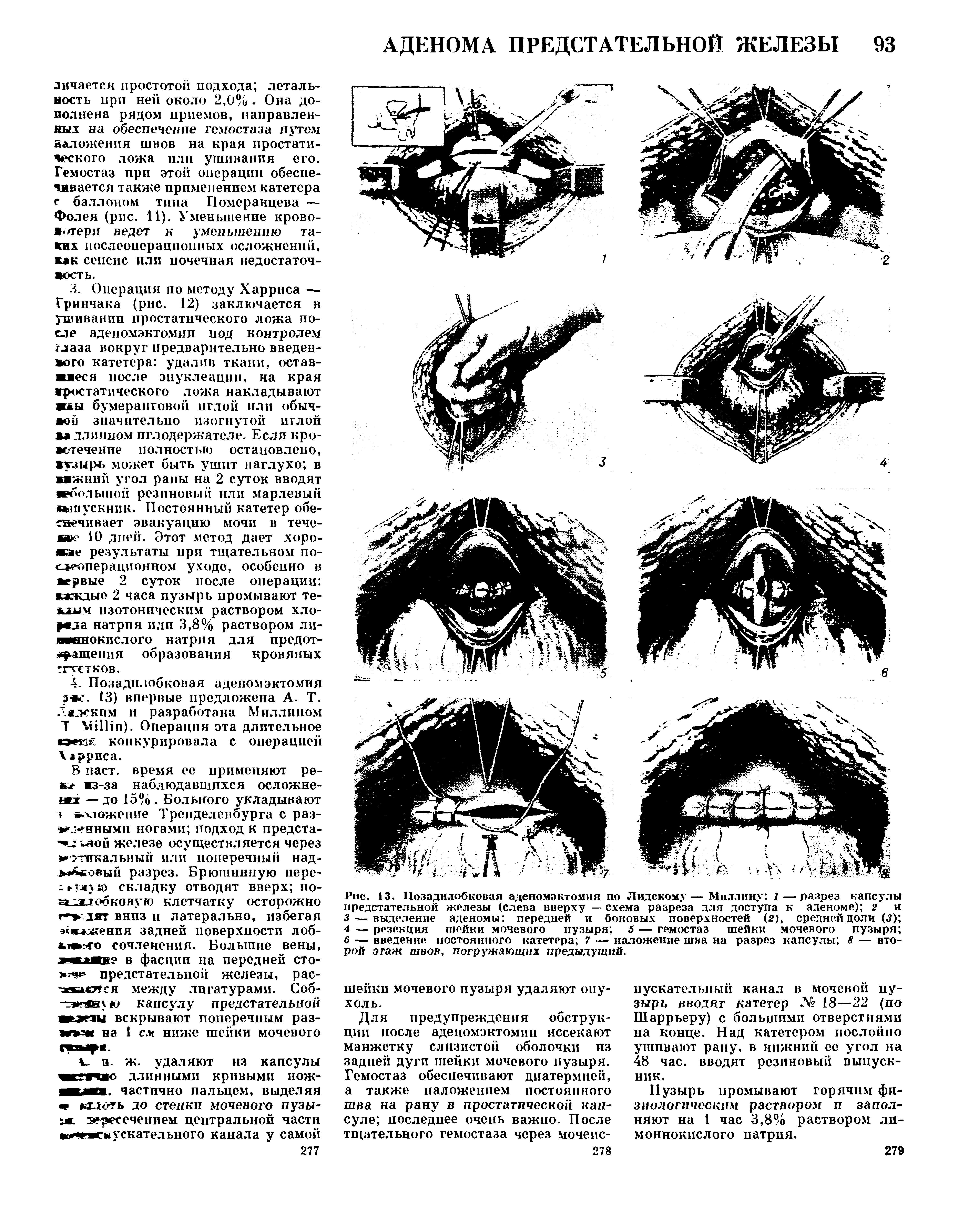 Рис. 13. Позадилобковая аденомэктомия по Лидскому— Миллину 1—разрез капсулы предстательной железы (слева вверху — схема разреза для доступа к аденоме) 2 и...