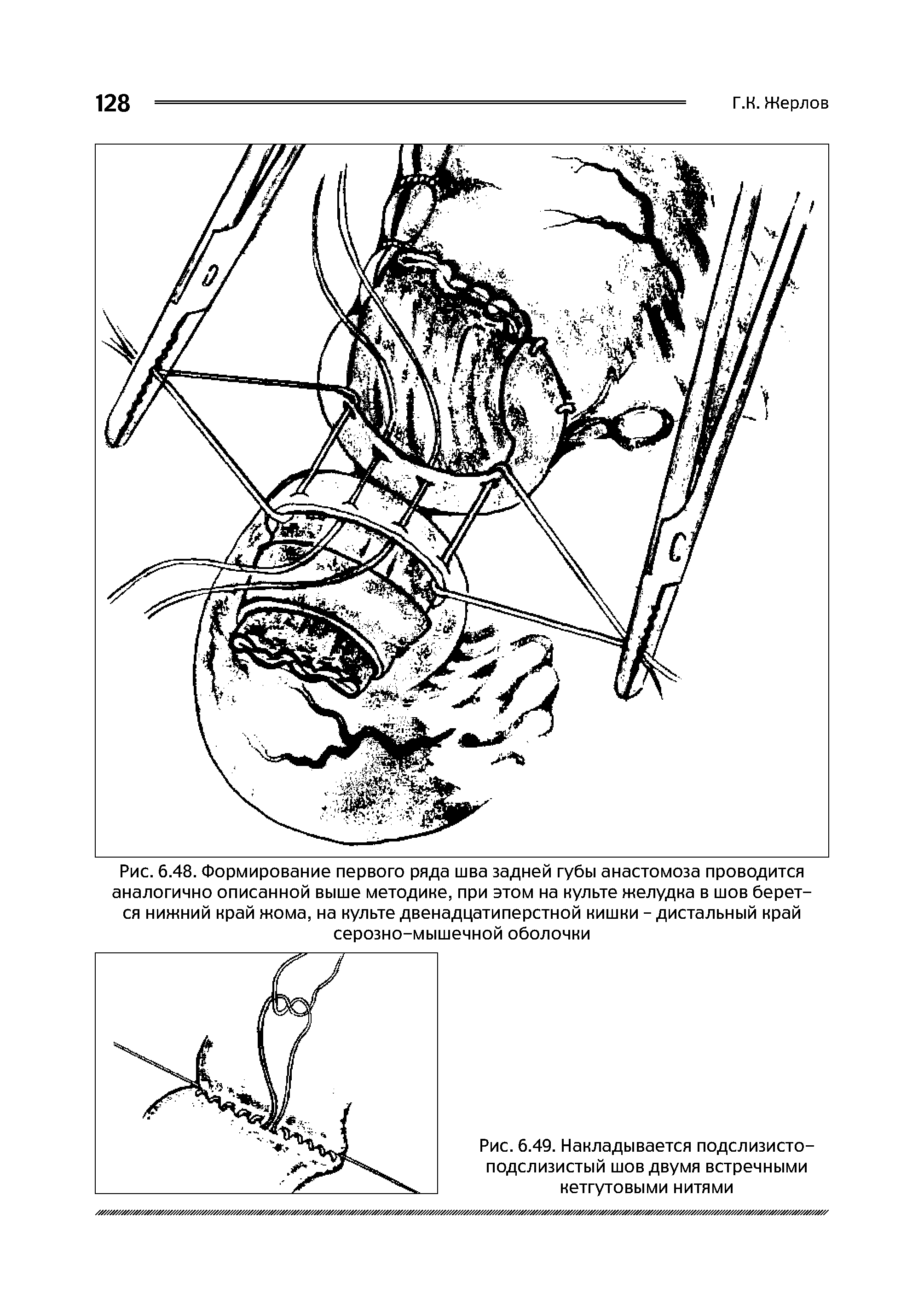 Рис. 6.48. Формирование первого ряда шва задней губы анастомоза проводится аналогично описанной выше методике, при этом на культе желудка в шов берется нижний край жома, на культе двенадцатиперстной кишки - дистальный край серозно-мышечной оболочки...