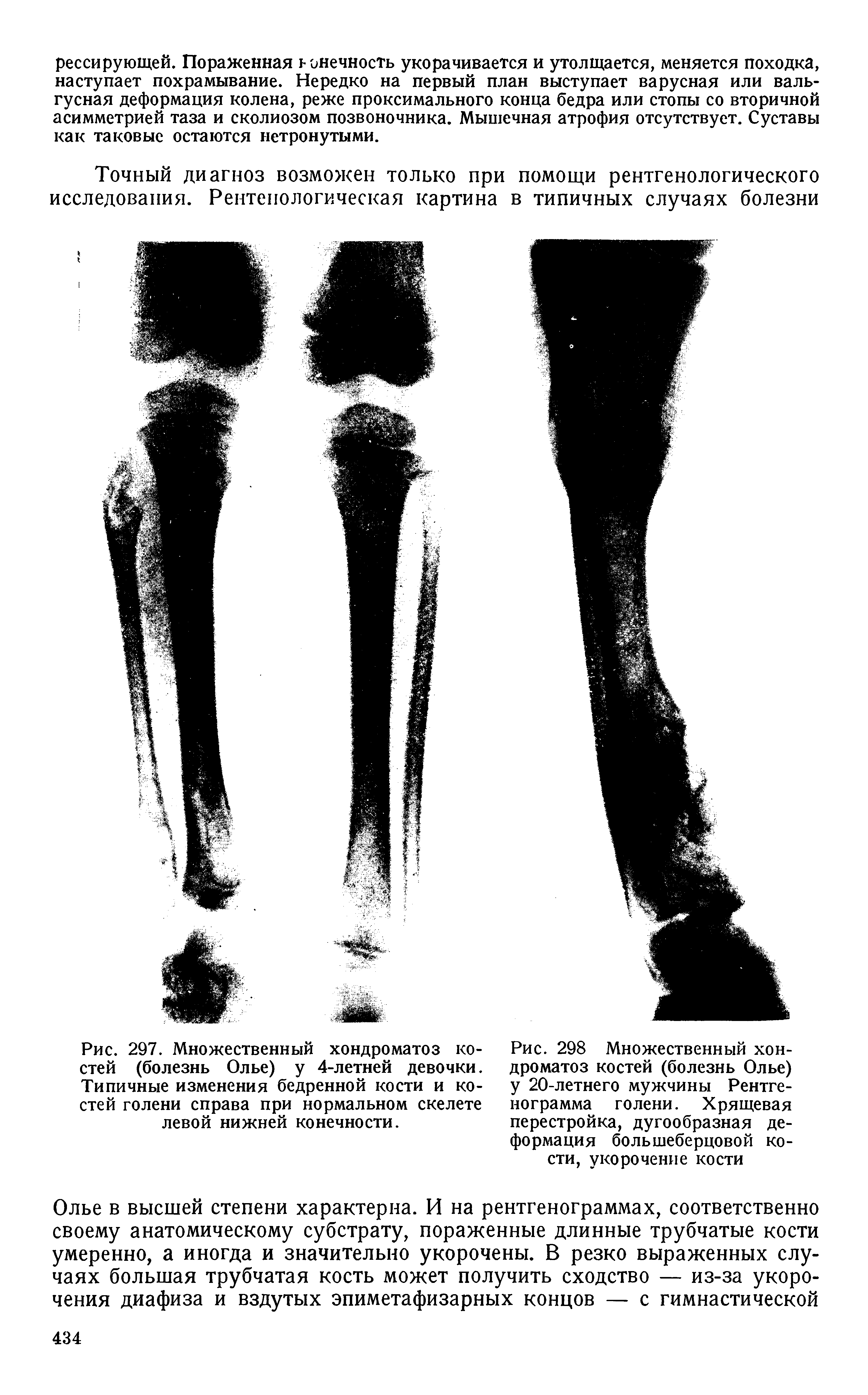 Рис. 297. Множественный хондроматоз костей (болезнь Олье) у 4-летней девочки. Типичные изменения бедренной кости и костей голени справа при нормальном скелете левой нижней конечности.