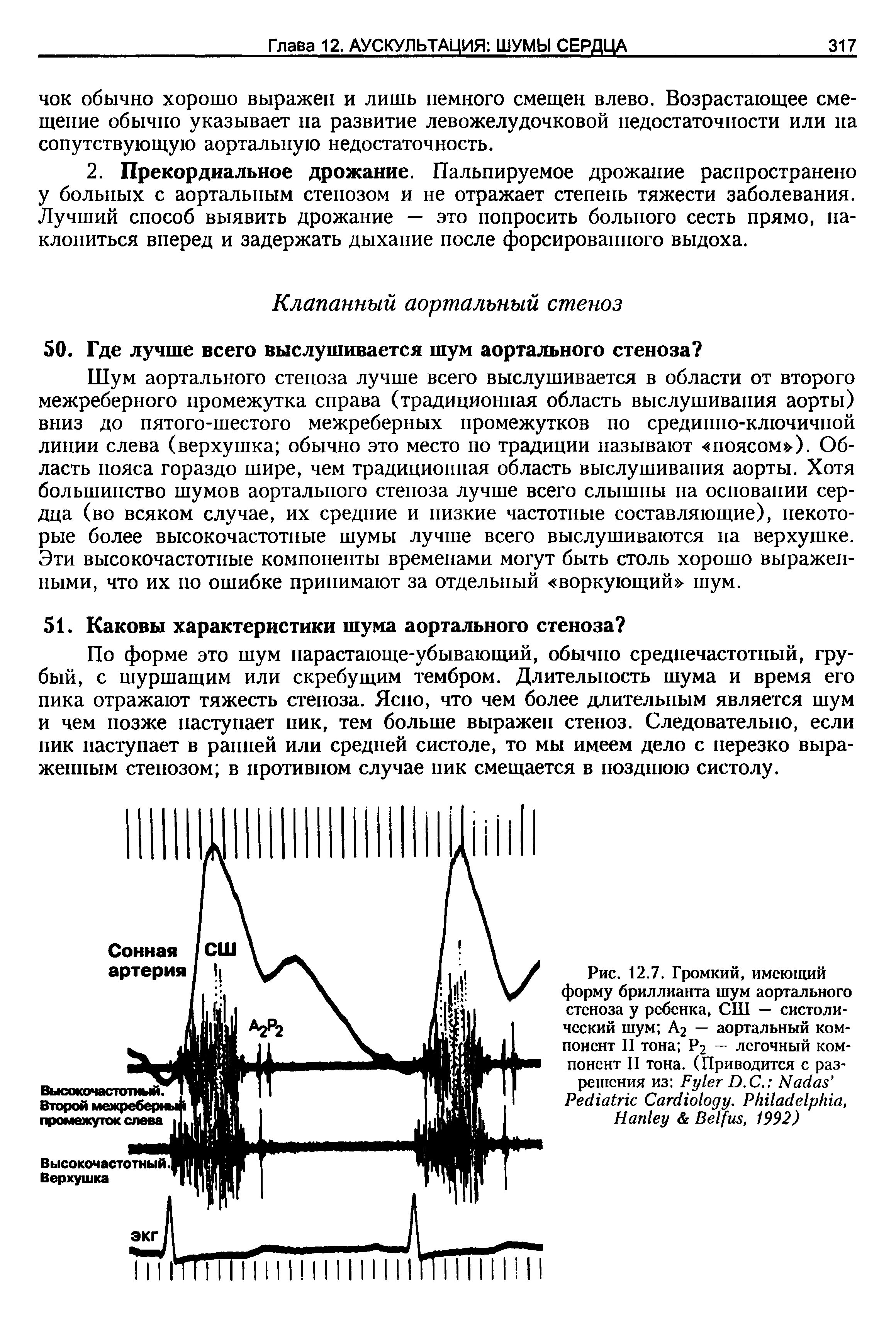 Рис. 12.7. Громкий, имеющий форму бриллианта шум аортального стеноза у ребенка, СШ — систолический шум Аг — аортальный компонент II тона Рг — легочный компонент II тона. (Приводится с разрешения из F D.C. N P C . P , H B , 1992)...
