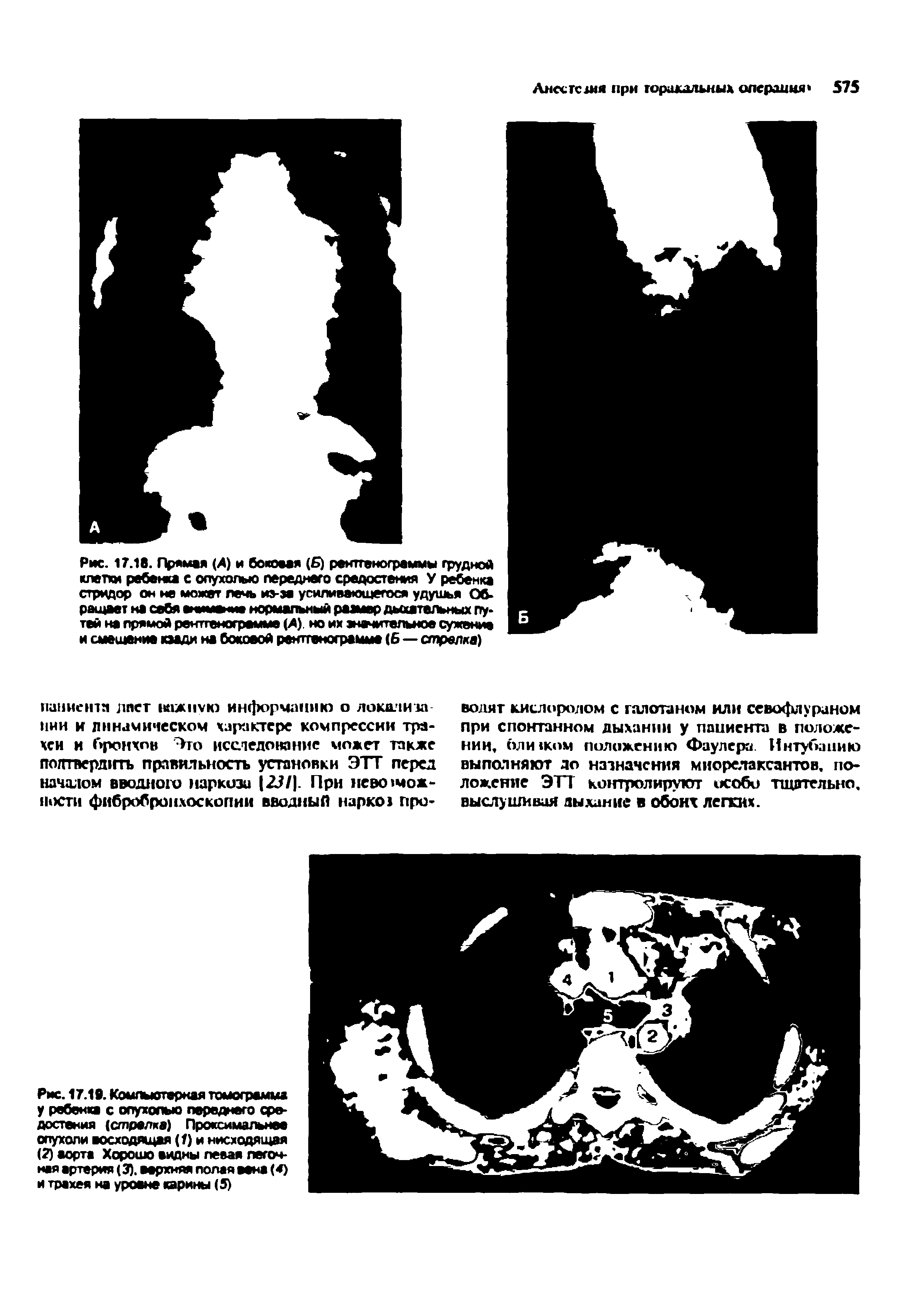 Рис. 17.18. Прямая (А) и боковая ( ) рентгенограммы грудной клетки ребенка с опухолью переднего средостения У ребенка стридор он не может лечь из-за усиливающегося удушья Обращает на себя внимание нормальный размер дьоатапьных путей на прямой рентгенограмме (Л). но их значительное сужение и смещение пади на боковой рентгенограмме (6 — стрелка)...