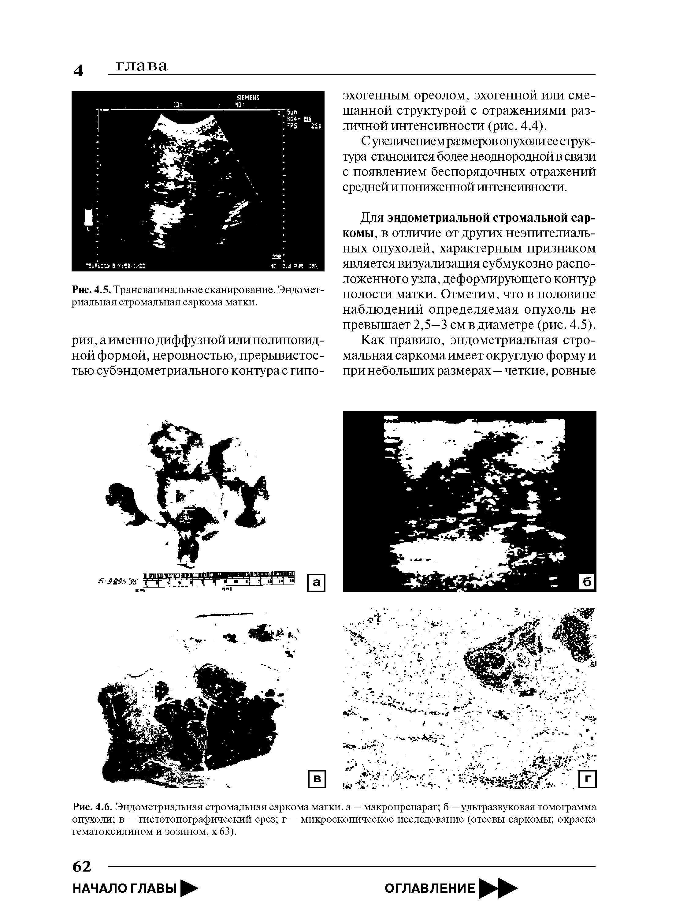 Рис. 4.6. Эндометриальная стромальная саркома матки, а — макропрепарат б — ультразвуковая томограмма опухоли в — гистотопографический срез г — микроскопическое исследование (отсевы саркомы окраска гематоксилином и эозином, х 63).