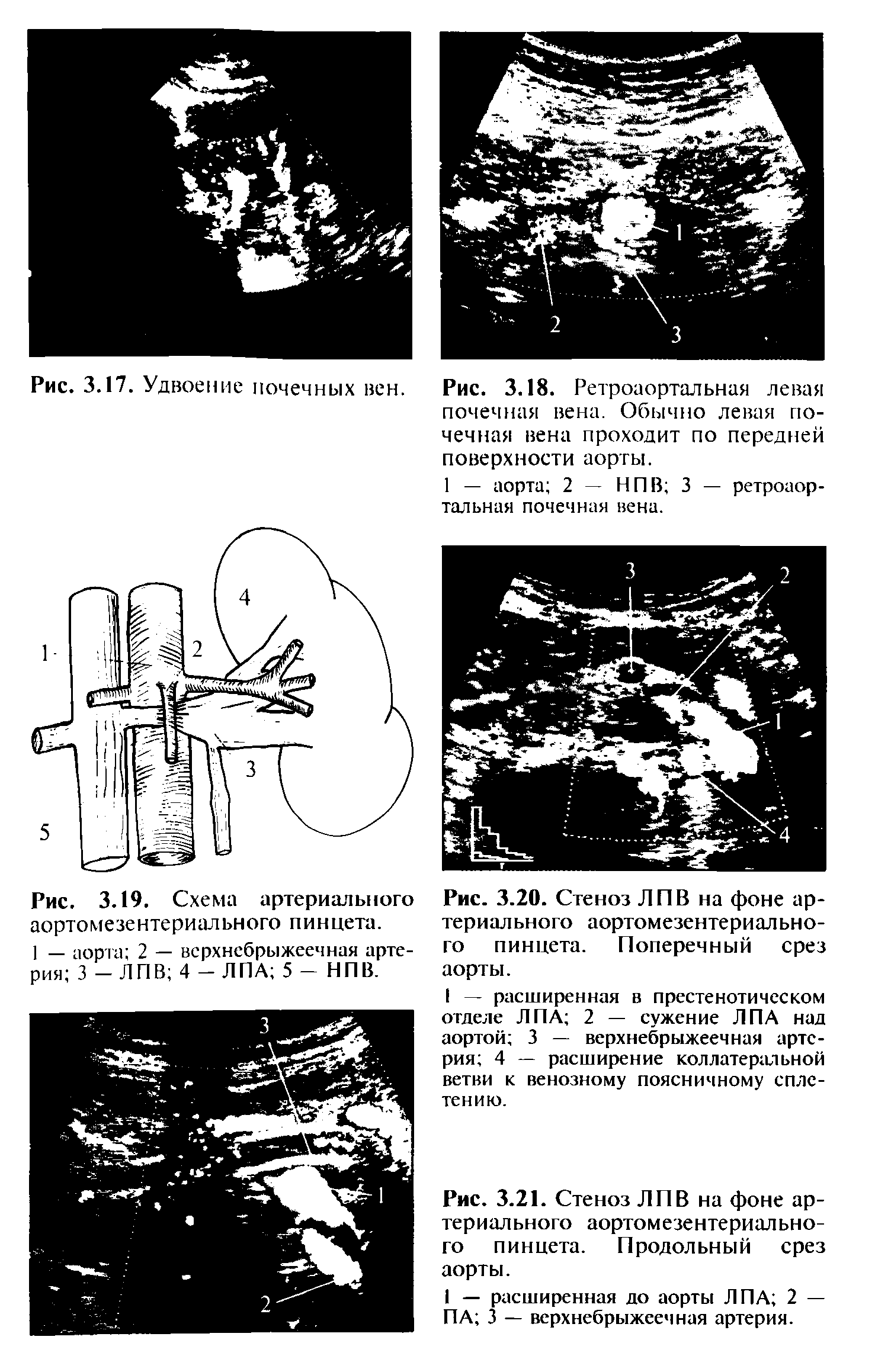 Рис. 3.18. Ретроаортальная левая почечная вена. Обычно левая почечная вена проходит по передней поверхности аорты.