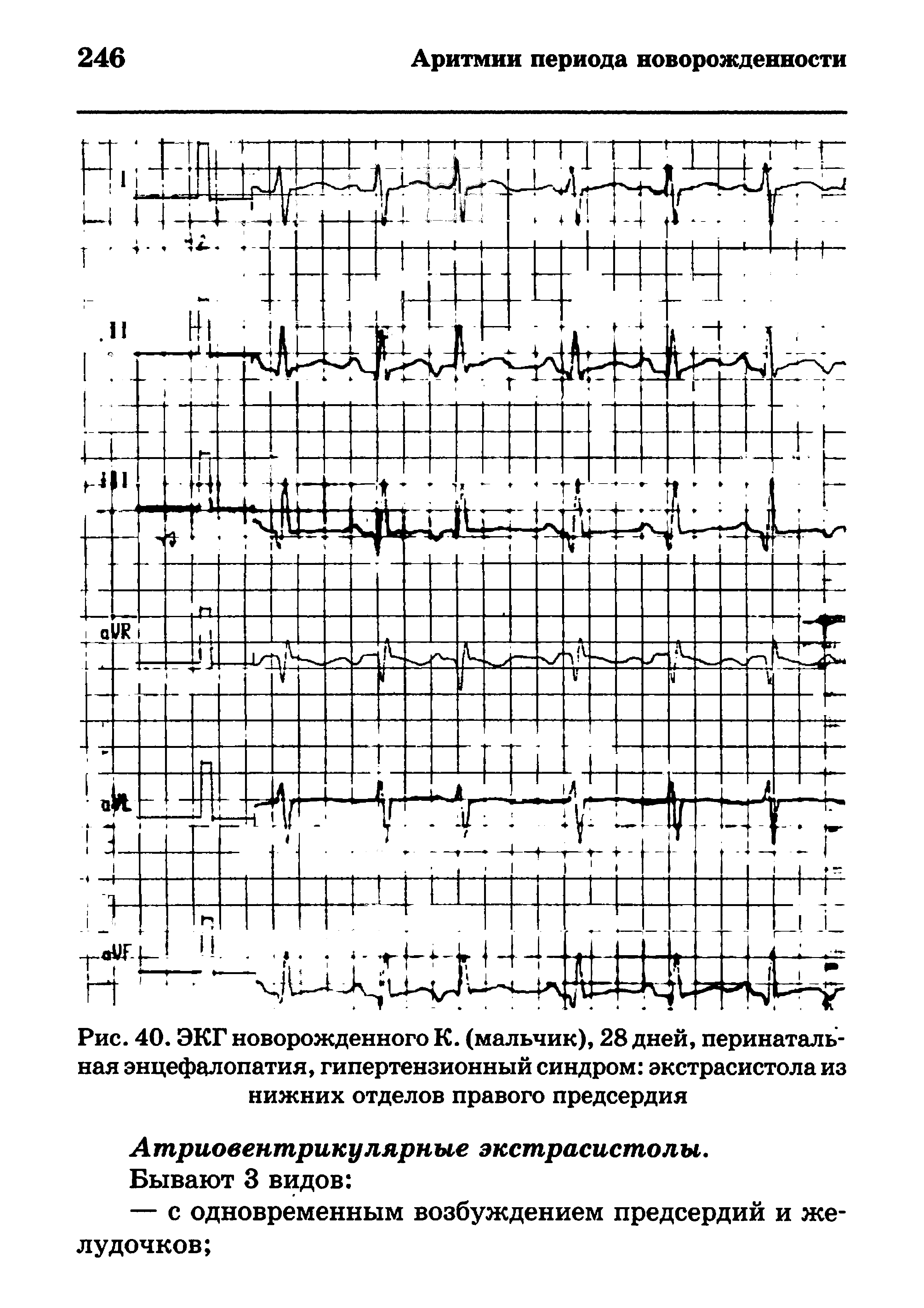 Рис. 40. ЭКГ новорожденного К. (мальчик), 28 дней, перинатальная энцефалопатия, гипертензионный синдром экстрасистола из нижних отделов правого предсердия...