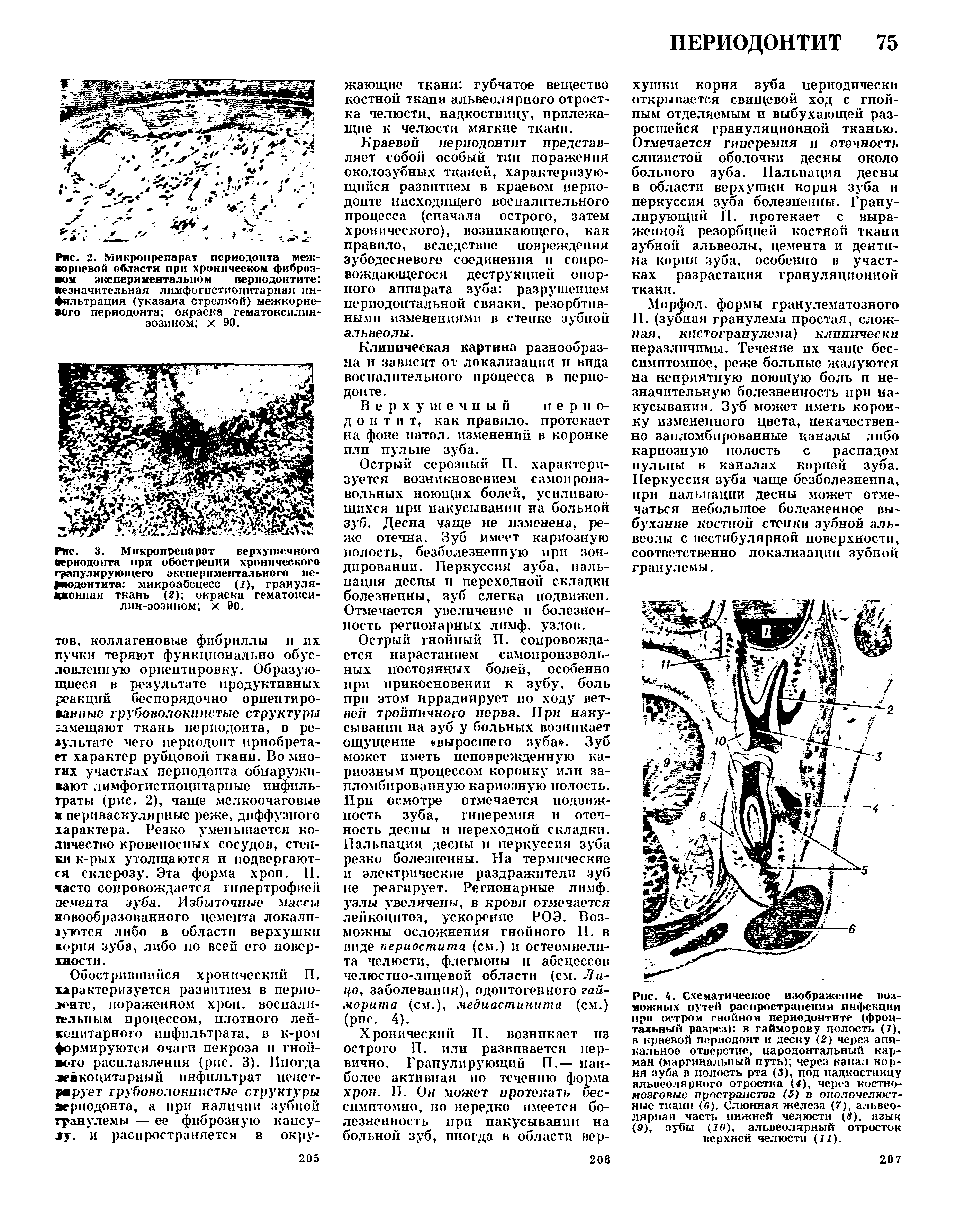 Рис. 2. Микропрепарат периодонта меж-ворневой области при хроническом фиброз- ом экспериментальном периодонтите езначитсльная лимфогпстиоцитарная инфильтрация (указана стрелкой) межкорневого периодонта окраска гематоксилин-эозином х 90.