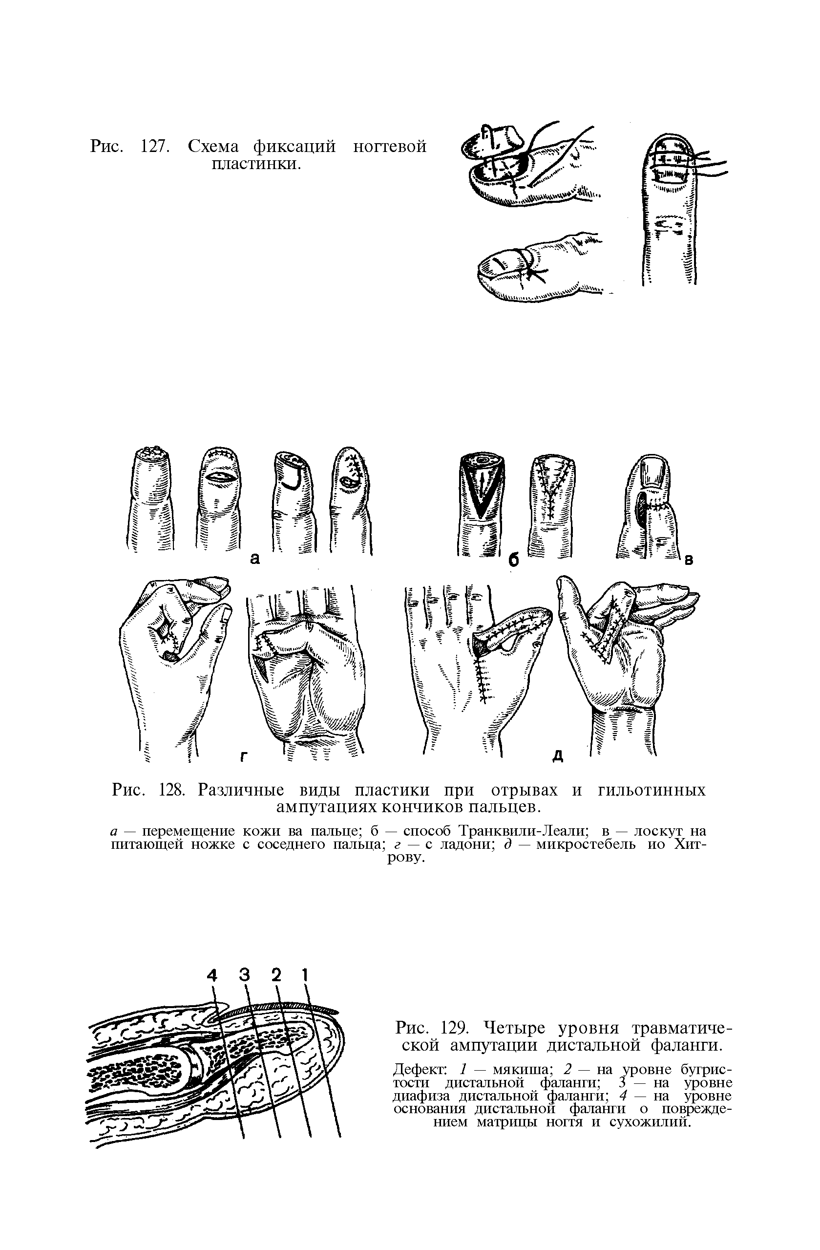 Рис. 129. Четыре уровня травматической ампутации дистальной фаланги.