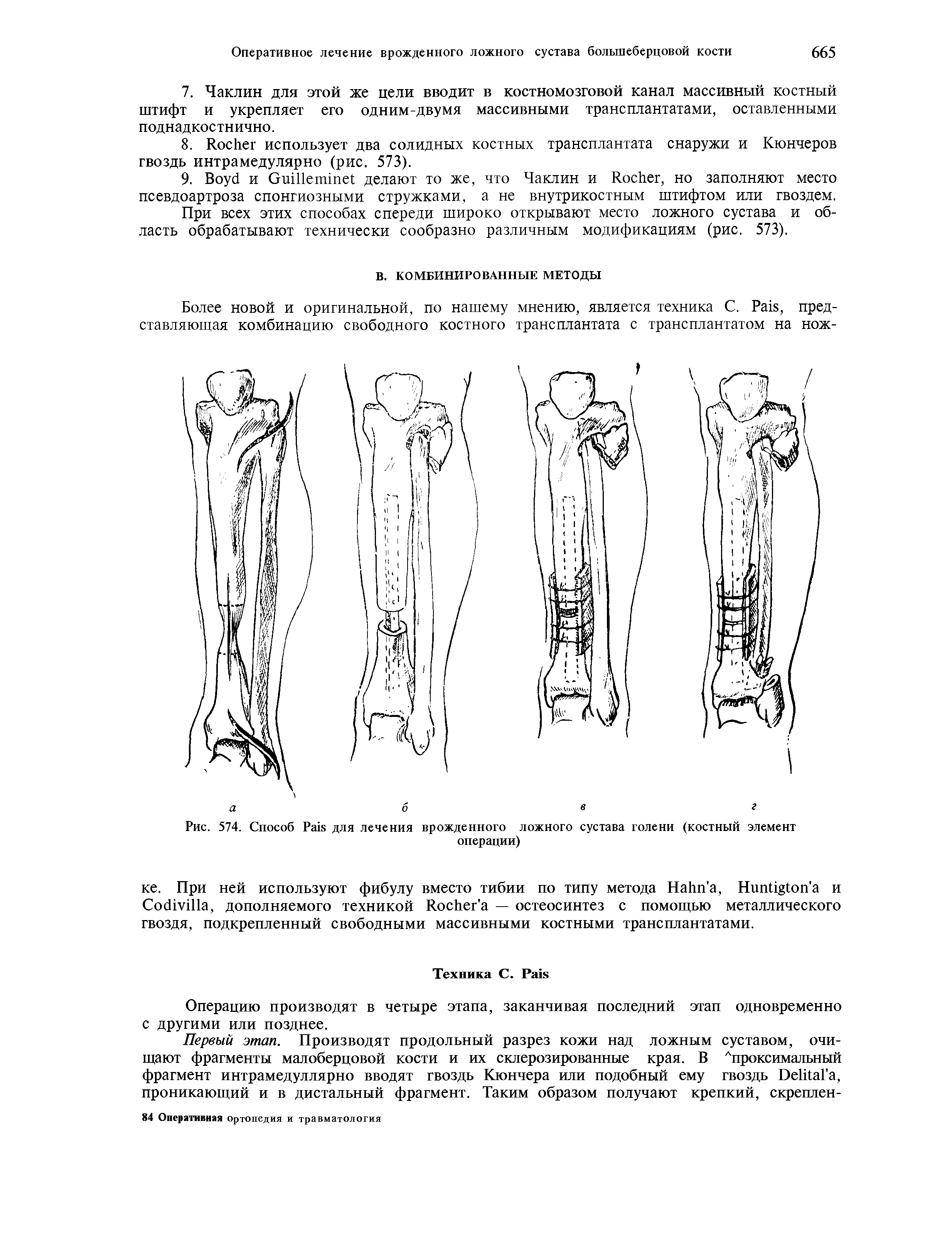 Рис. 574. Способ P для лечения врожденного ложного сустава голени (костный элемент операции)...
