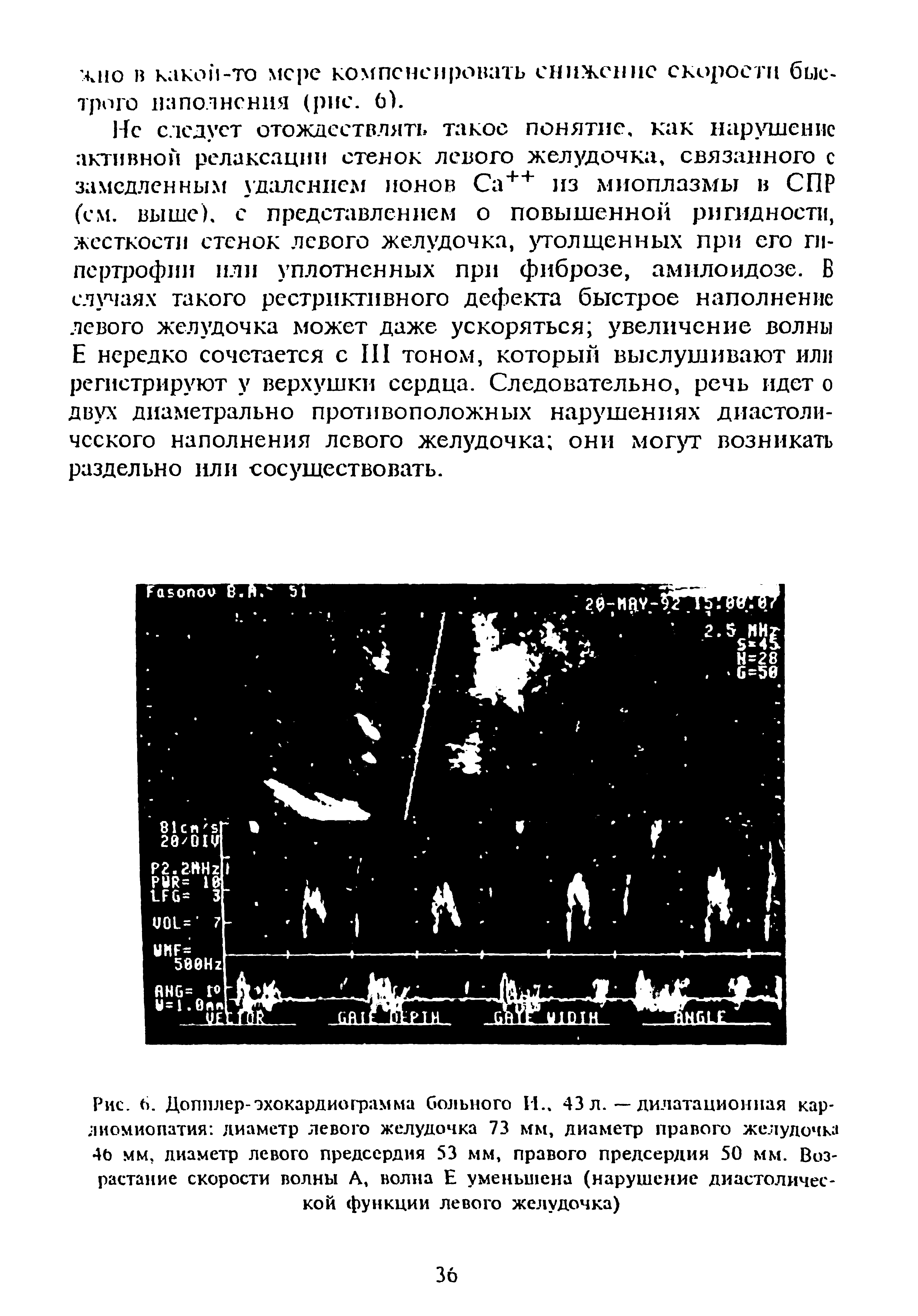 Рис. 6. Допплер-эхокардиограмма больного И., 43 л. — дилатационная кардиомиопатия диаметр левого желудочка 73 мм, диаметр правого желудочка 40 мм, диаметр левого предсердия 53 мм, правого предсердия 50 мм. Возрастание скорости волны А, волна Е уменьшена (нарушение диастолической функции левого желудочка)...