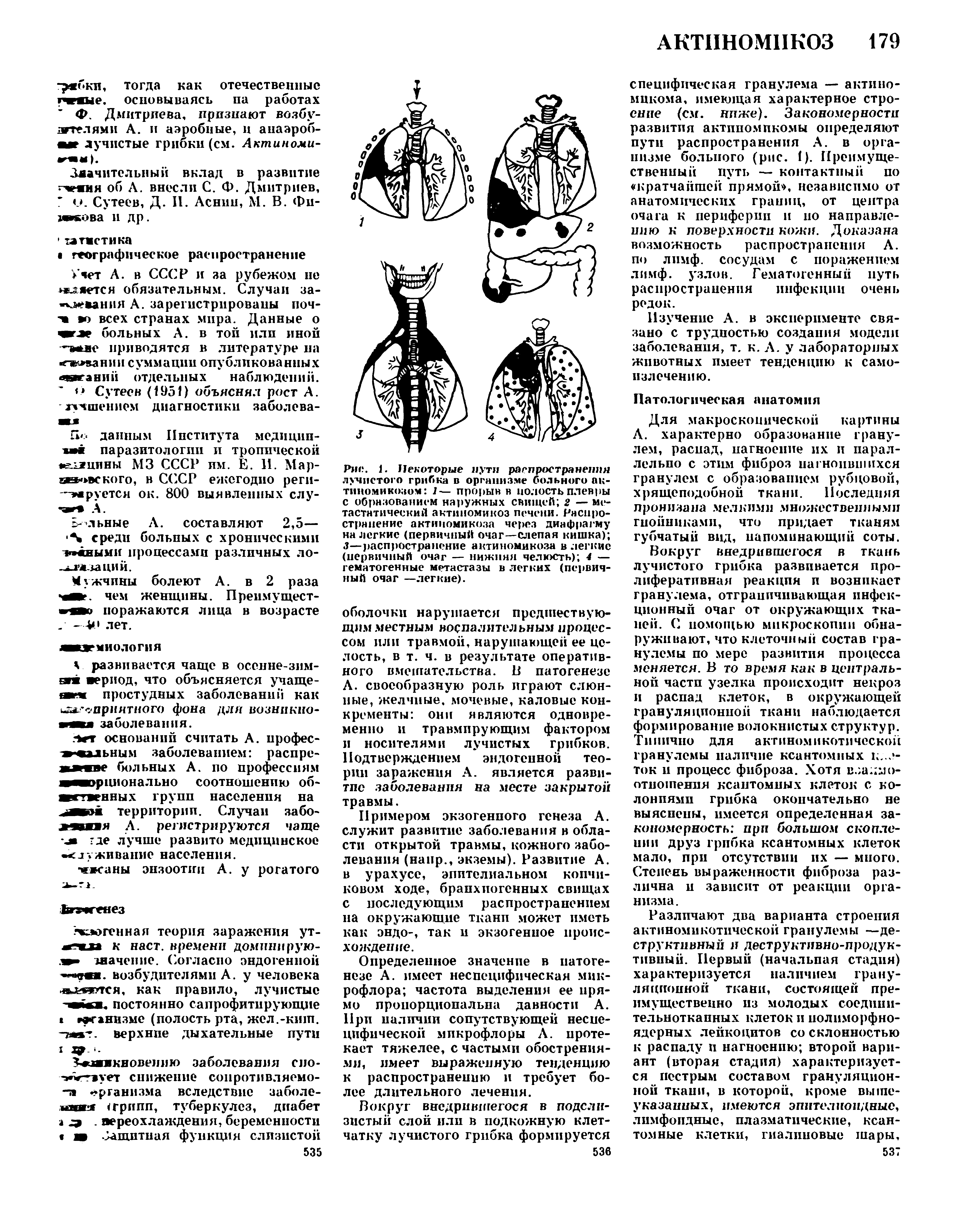 Рис. 1. Некоторые пути распространение лучистого грибка в организме больного актиномикозом 1— прорыв в полость плевры с образованием наружных свищей 2 — метастатический актиномикоз печени. Распространение актиномикоза через диафрагму на легкие (первичный очаг—слепая кишка) 3—распространение актиномикоза в легкие (первичный очаг — нижняя челюсть) 4 — гематогенные метастазы в легких (первичный очаг —легкие).