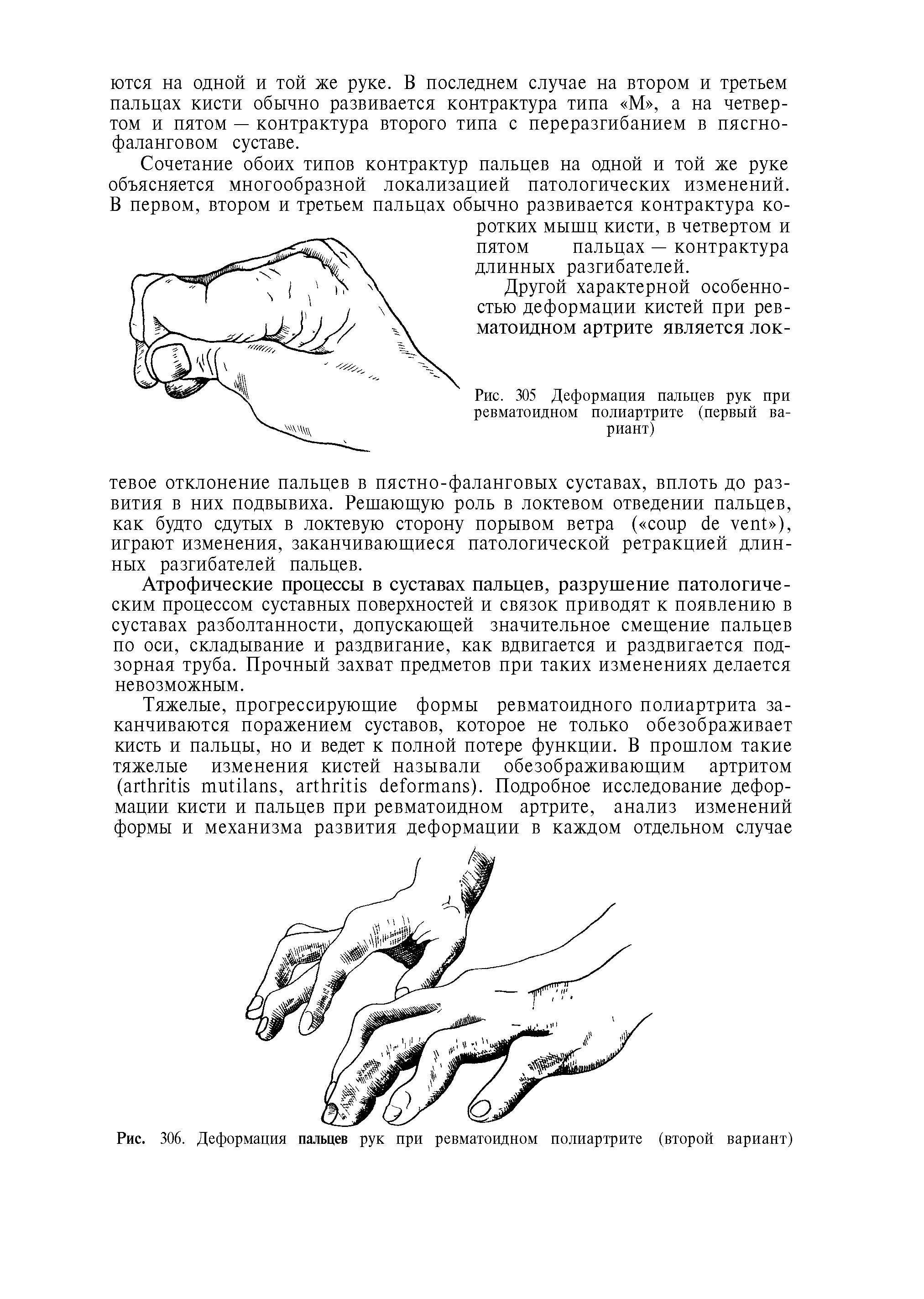 Рис. 305 Деформация пальцев рук при ревматоидном полиартрите (первый вариант)...