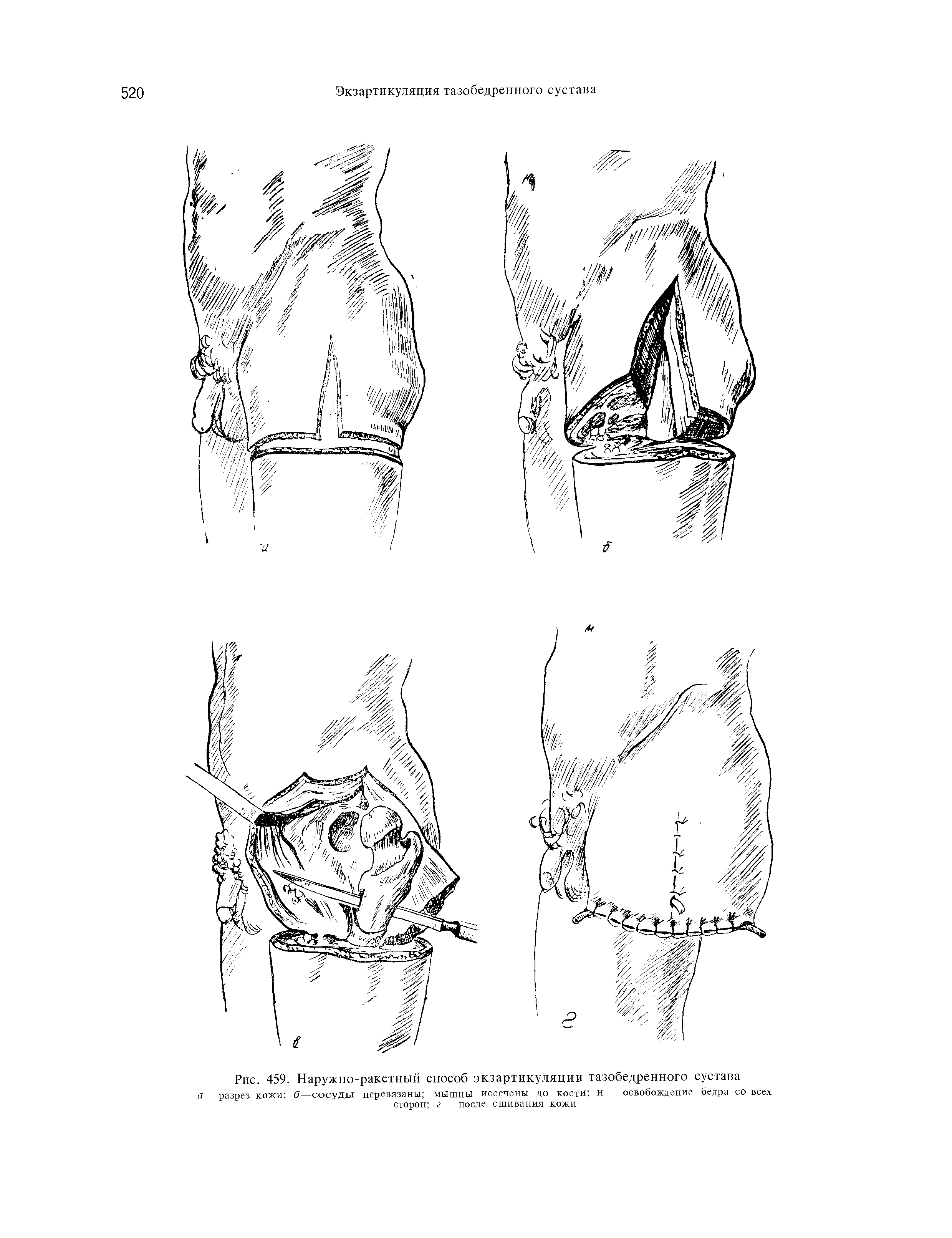 Рис. 459. Наружно-ракетный способ экзартикуляции тазобедренного сустава а— разрез кожи б— сосуды перевязаны мышцы иссечены до кости н — освобождение бедра со всех сторон г — после сшивания кожи...