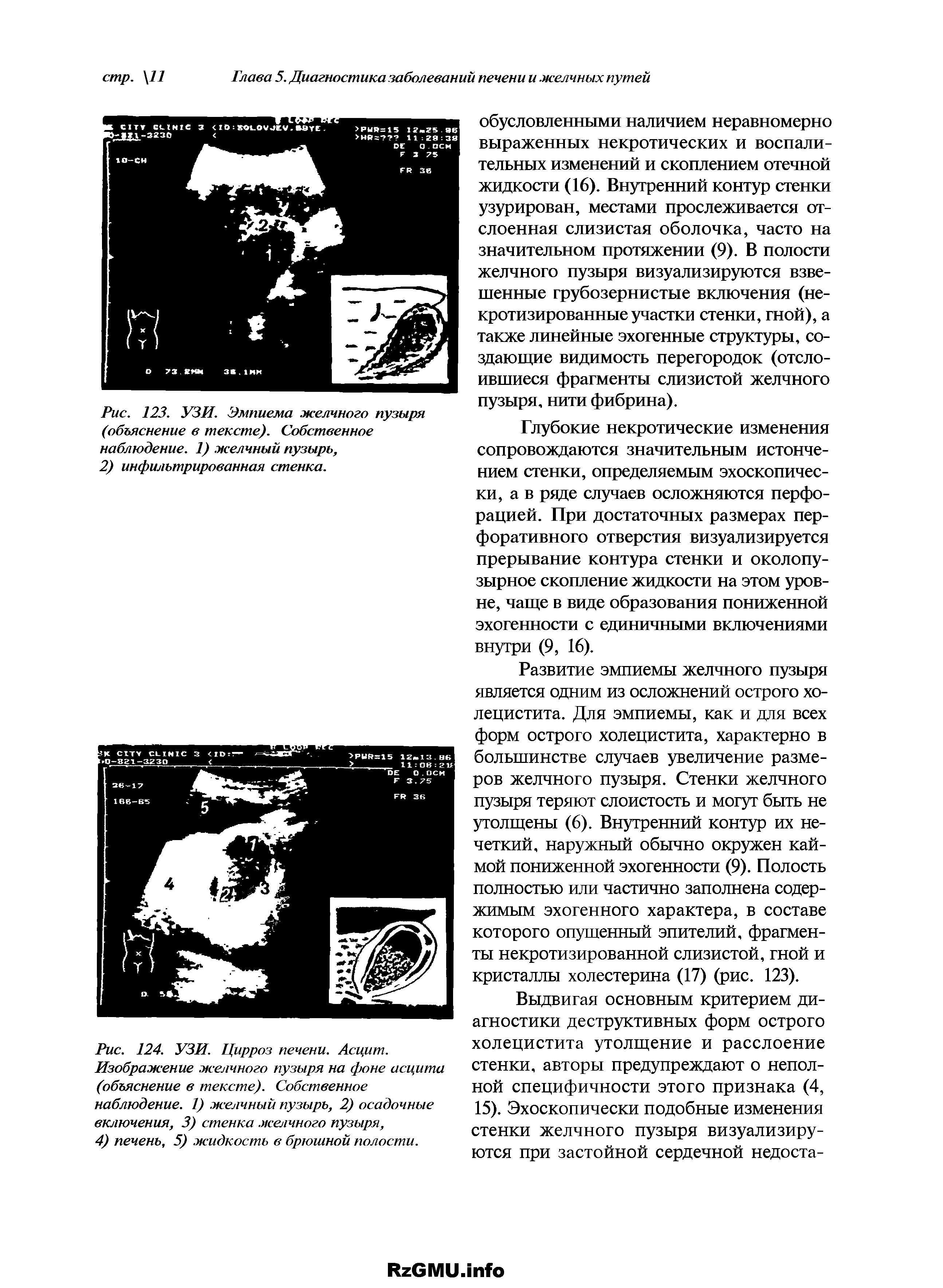 Рис. 123. УЗИ. Эмпиема желчного пузыря (объяснение в тексте). Собственное наблюдение. 1) желчный пузырь,...