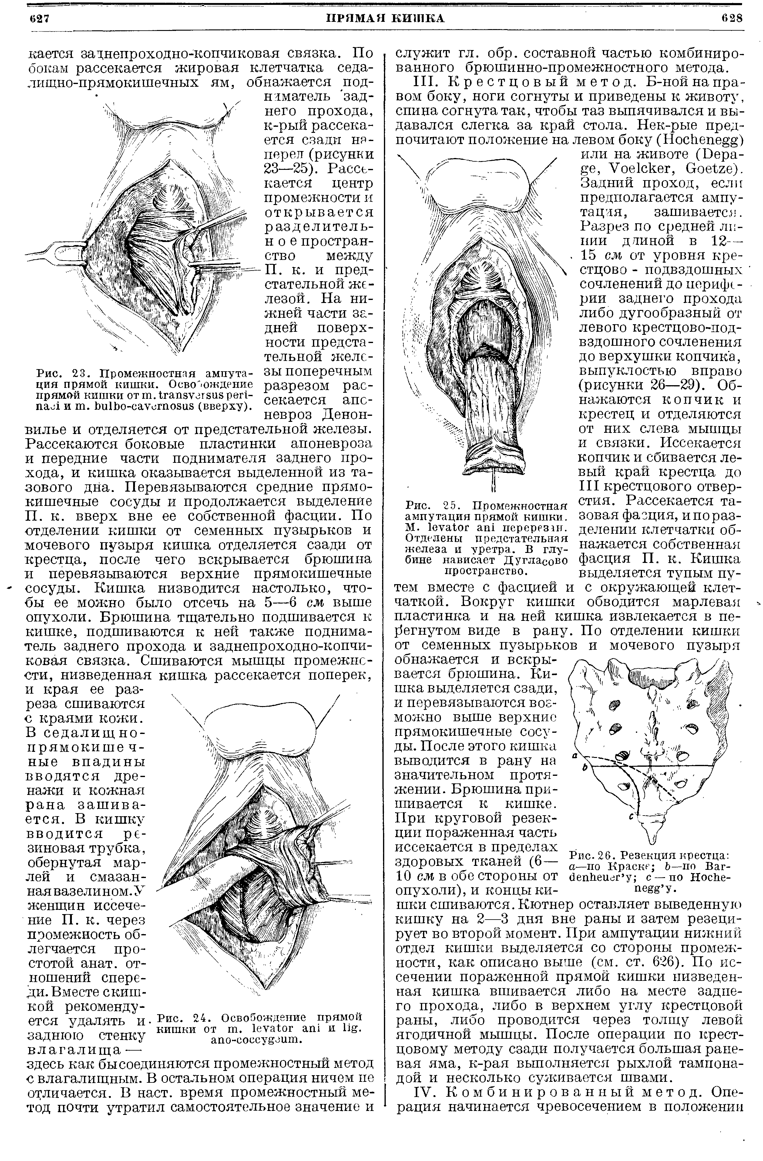 Рис. 25. Промежностная ампутация прямой кишки. М. перерезан. Отделены предстательная железа и уретра. В глубине нависает ДуглаСово пространство.