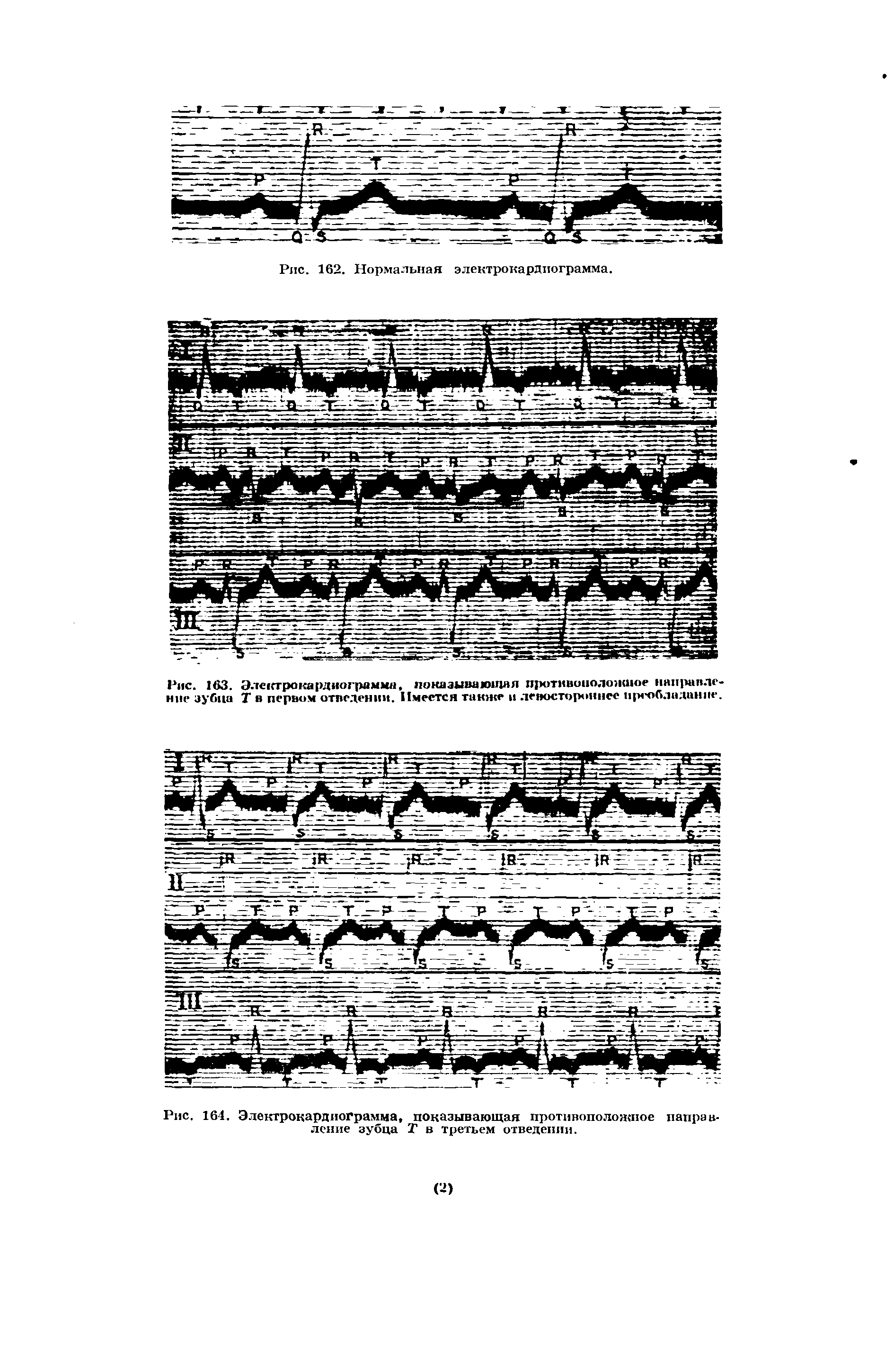 Рис. 164. Электрокардиограмма, показывающая противоположное направление зубца Т в третьем отведении.