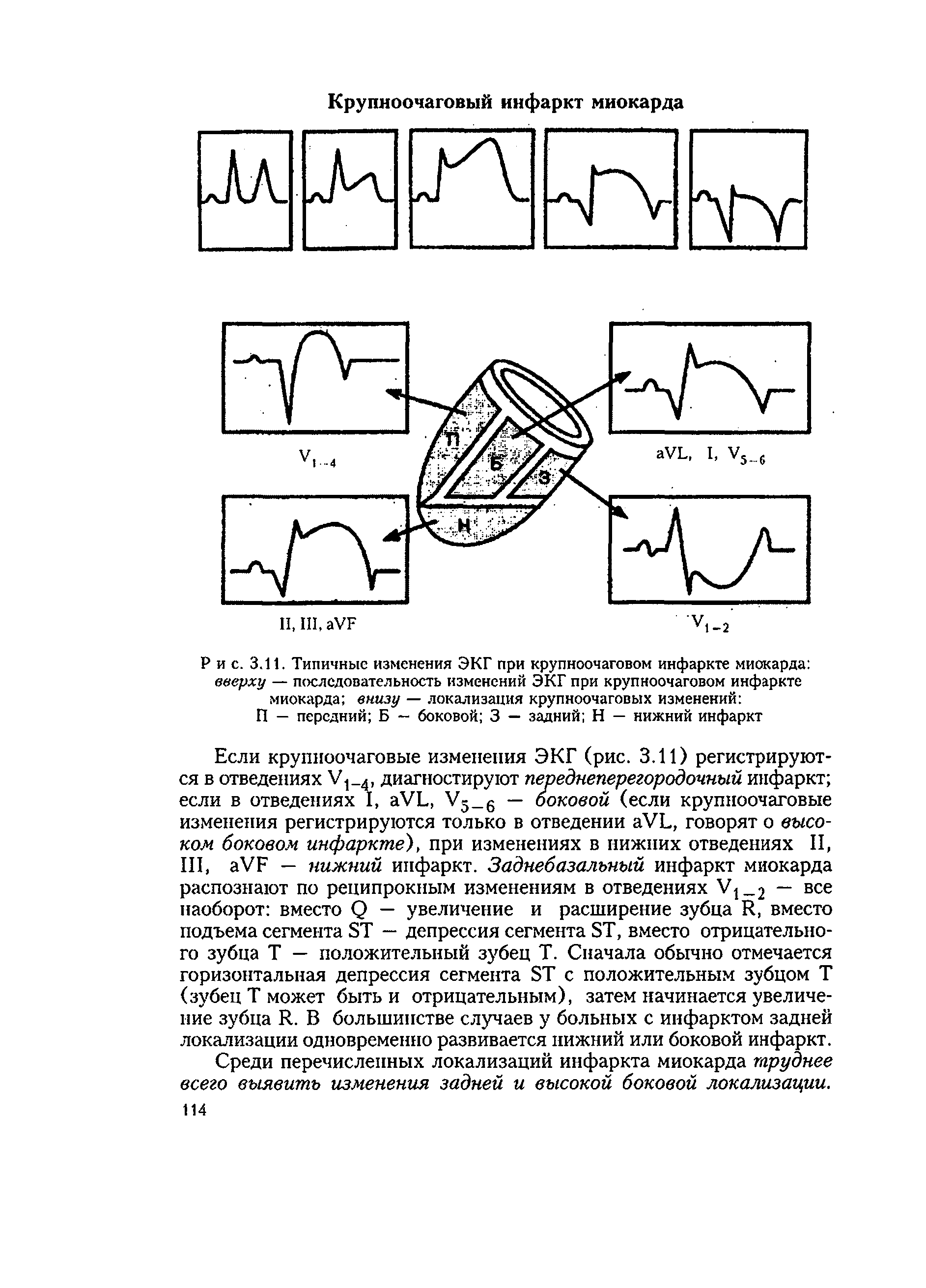 Рис. 3.11. Типичные изменения ЭКГ при крупноочаговом инфаркте миокарда вверху — последовательность изменений ЭКГ при крупноочаговом инфаркте миокарда внизу — локализация крупноочаговых изменений П — передний Б — боковой 3 — задний Н — нижний инфаркт...