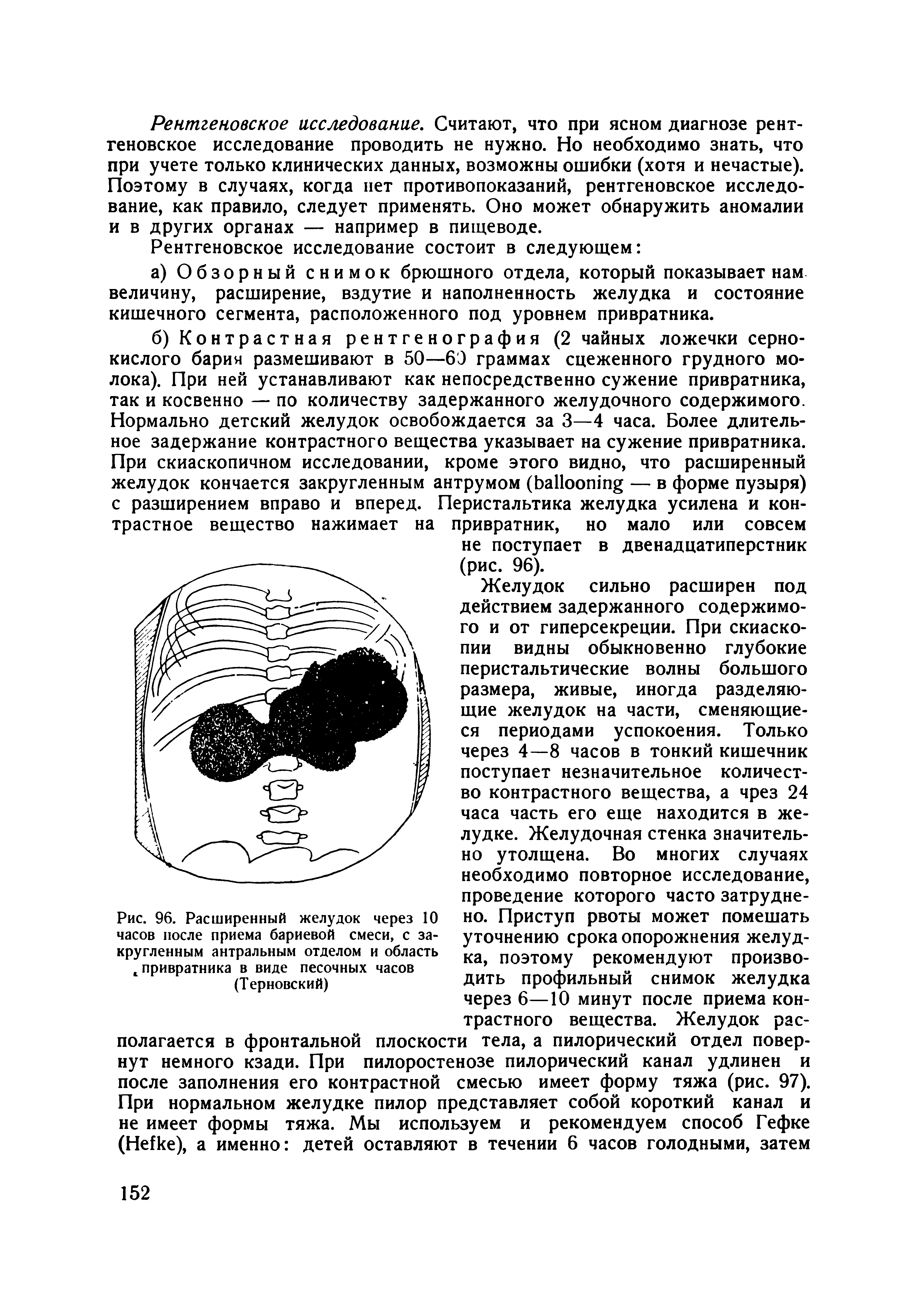 Рис. 96. Расширенный желудок через 10 часов после приема бариевой смеси, с закругленным антральным отделом и область с привратника в виде песочных часов (Терновский)...