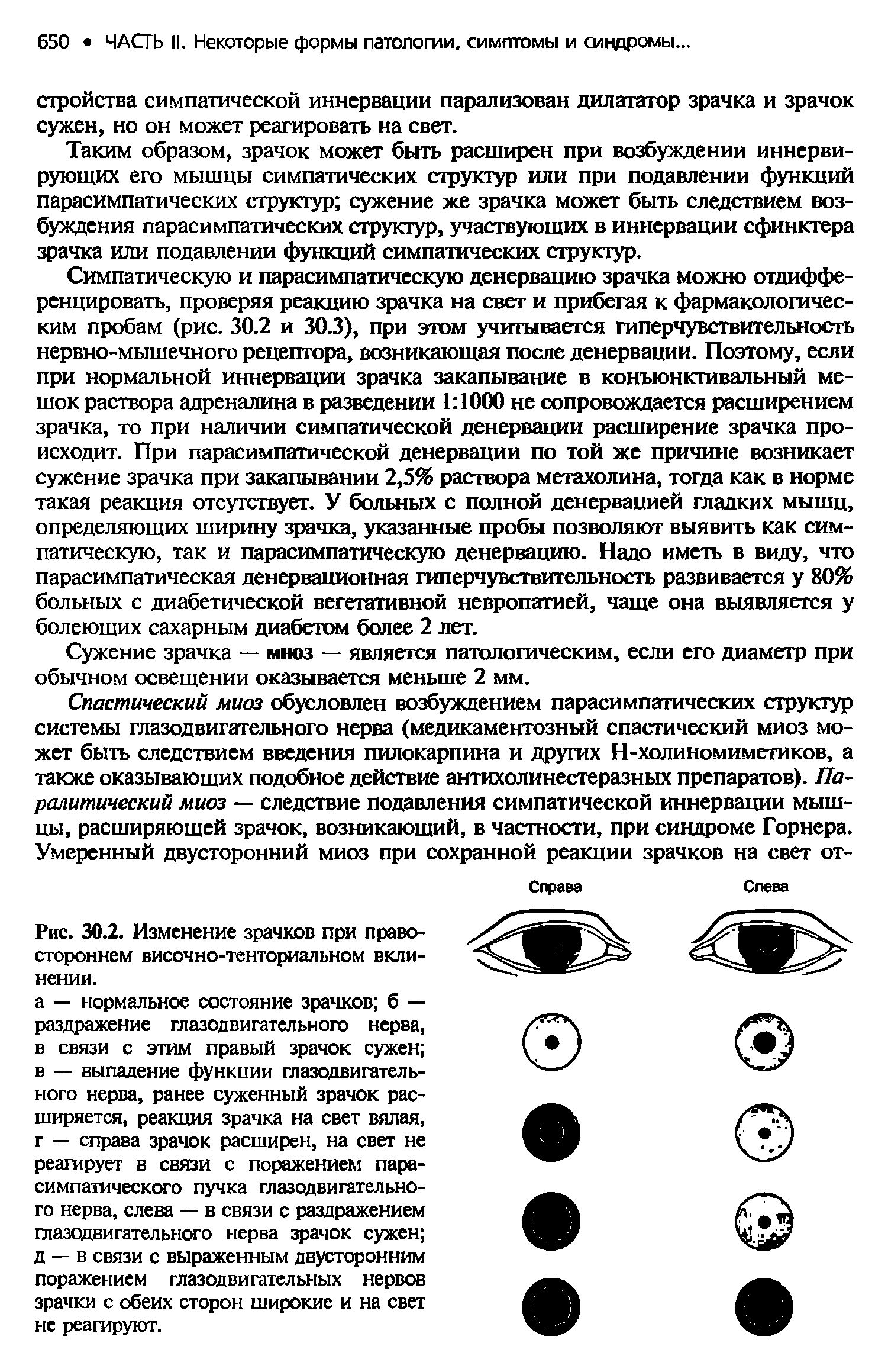 Рис. 30.2. Изменение зрачков при правостороннем височно-тенториальном вклинении.