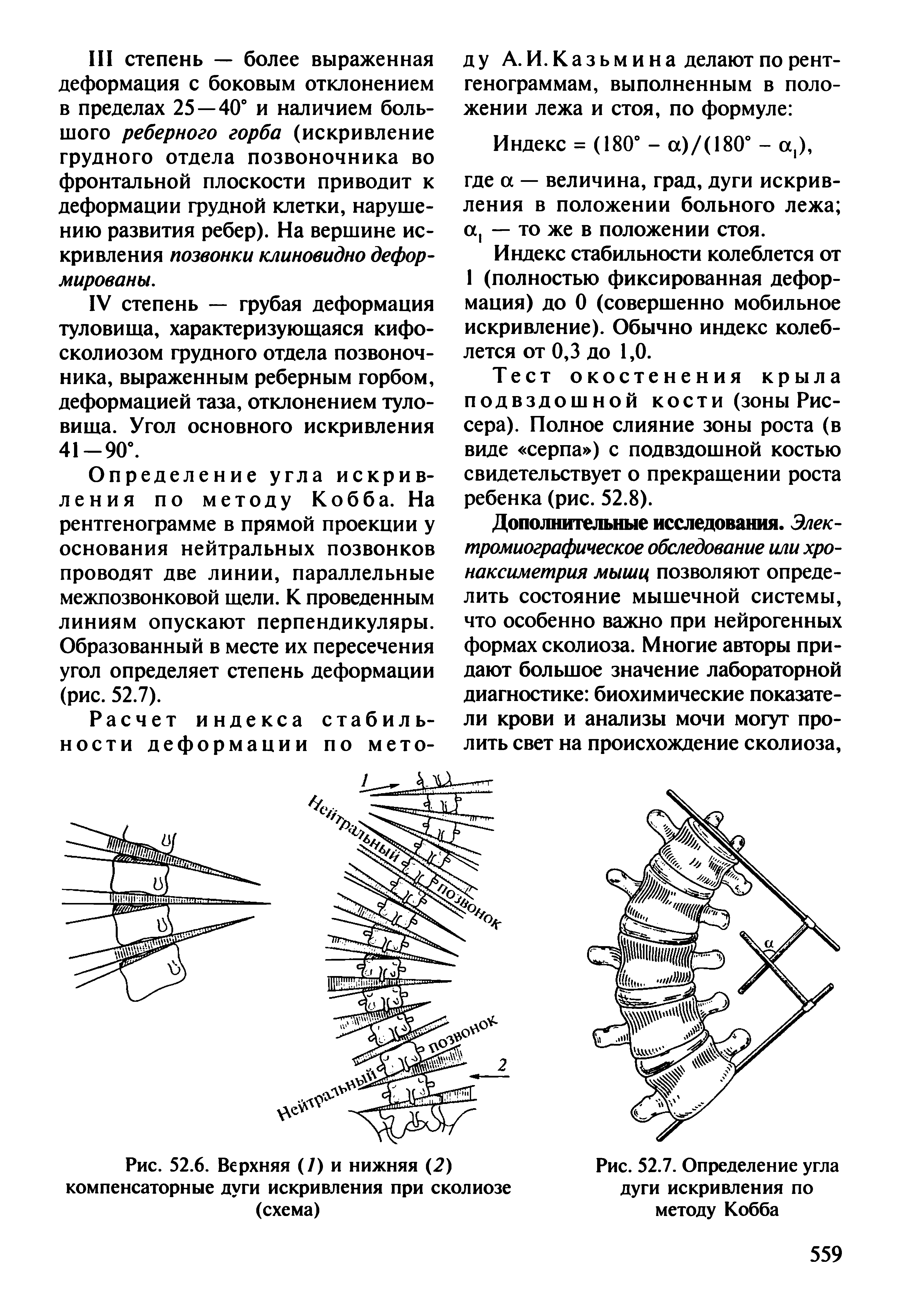 Рис. 52.7. Определение угла дуги искривления по методу Кобба...