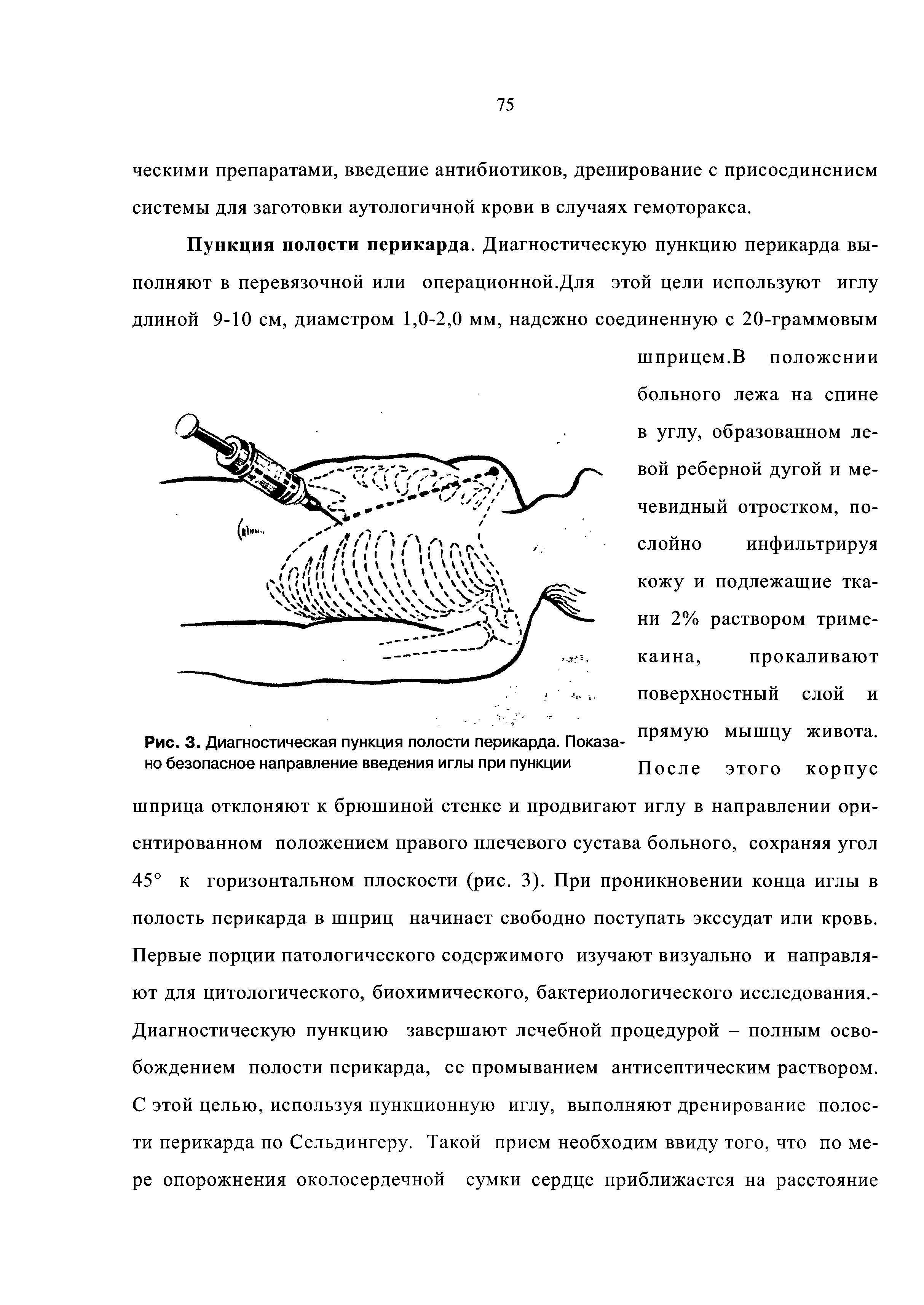 Рис. 3. Диагностическая пункция полости перикарда. Показа- ПРЯМУЮ но безопасное направление введения иглы при пункции После...