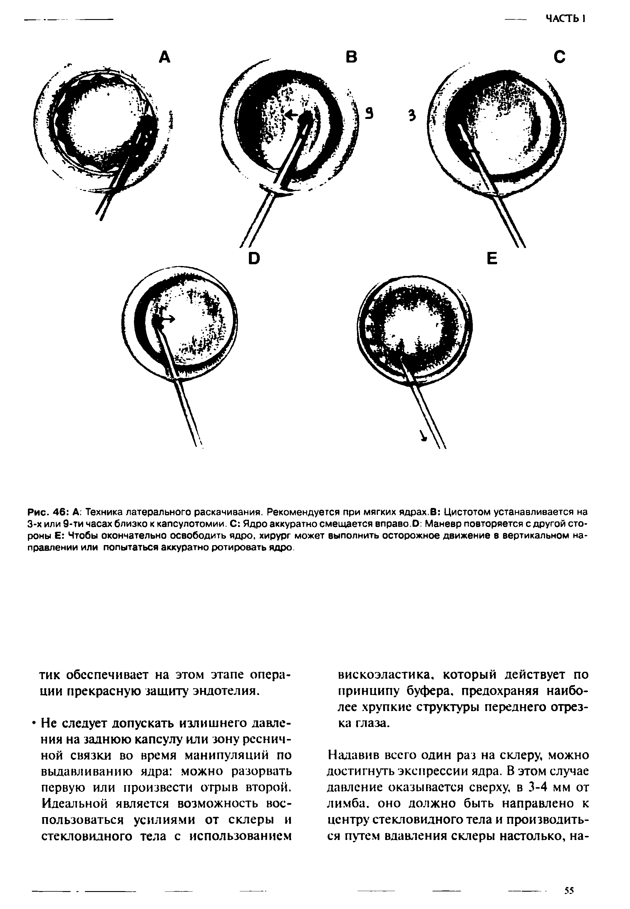 Рис. 46 А Техника латерального раскачивания. Рекомендуется при мягких ядрах.В Цистотом устанавливается на 3-х или 9-ти часах близко к капсулотомии. С Ядро аккуратно смещается вправо.О Маневр повторяется с другой стороны Е Чтобы окончательно освободить ядро, хирург может выполнить осторожное движение в вертикальном направлении или попытаться аккуратно ротировать ядро...