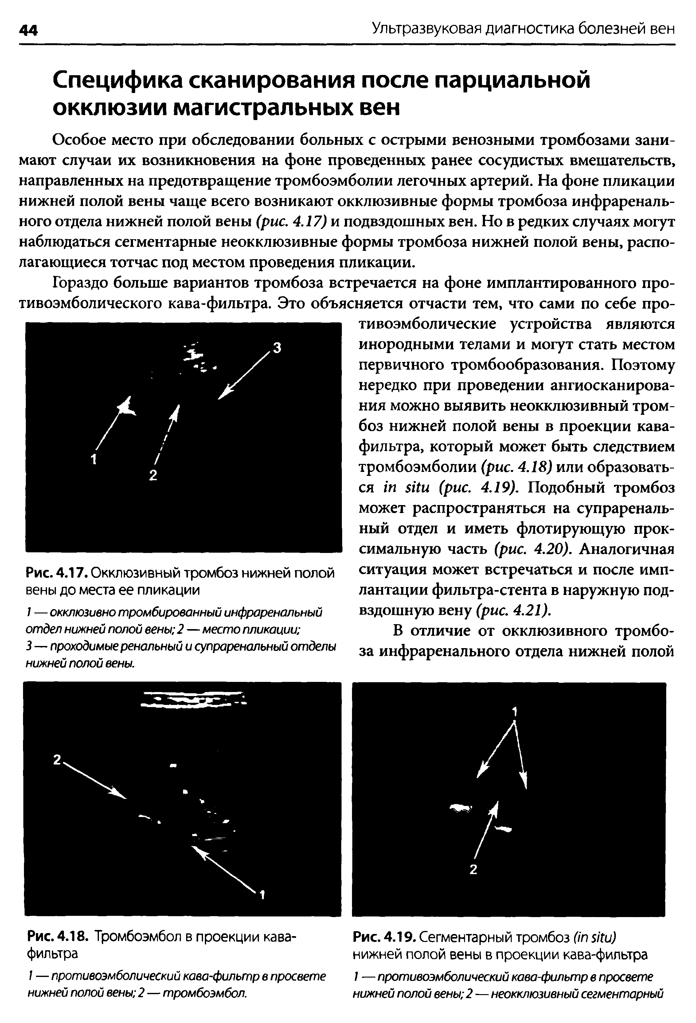 Рис. 4.19. Сегментарный тромбоз ( ) нижней полой вены в проекции кава-фильтра / — противоэмболический кава-фильтр в просвете нижней полой вены 2—неокклюзивный сегментарный...