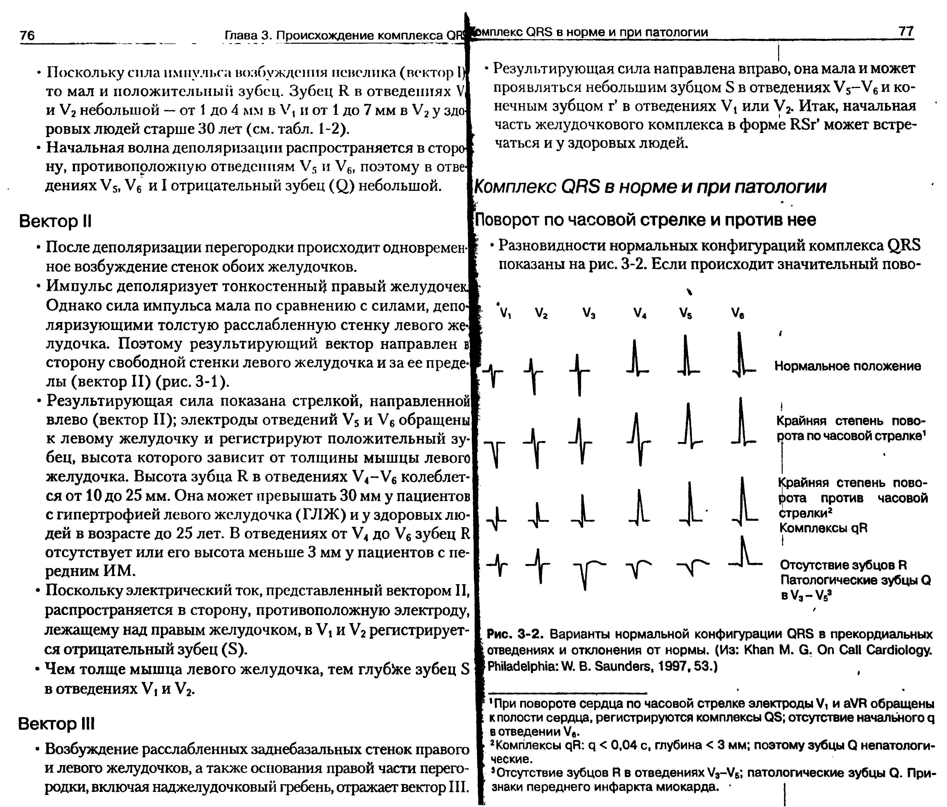 Рис. 3-2. Варианты нормальной конфигурации QRS в прекордиальных отведениях и отклонения от нормы. (Из K М. G. O C C . P W. В. S , 1997,53.) (...