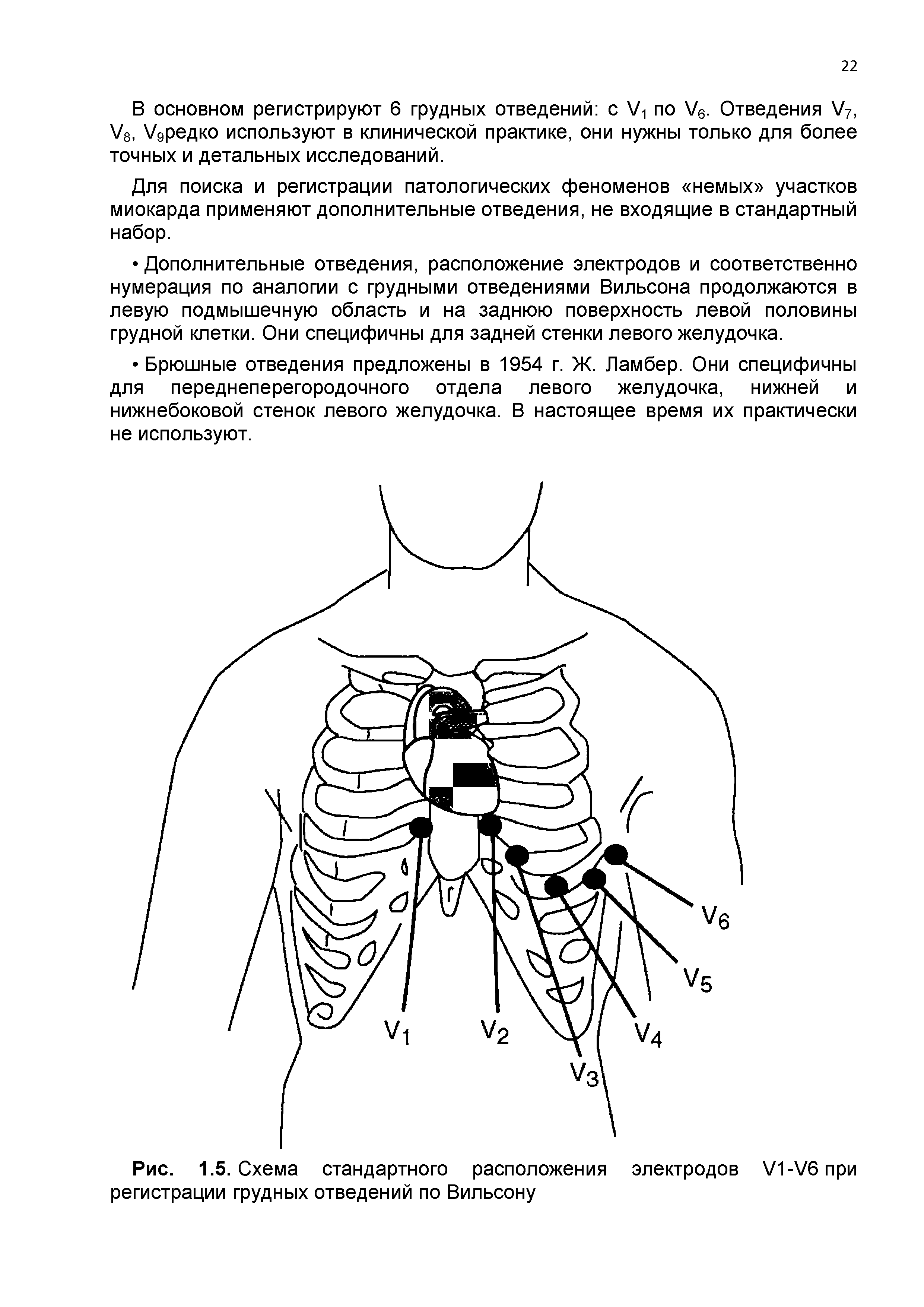 Рис. 1.5. Схема стандартного расположения регистрации грудных отведений по Вильсону...